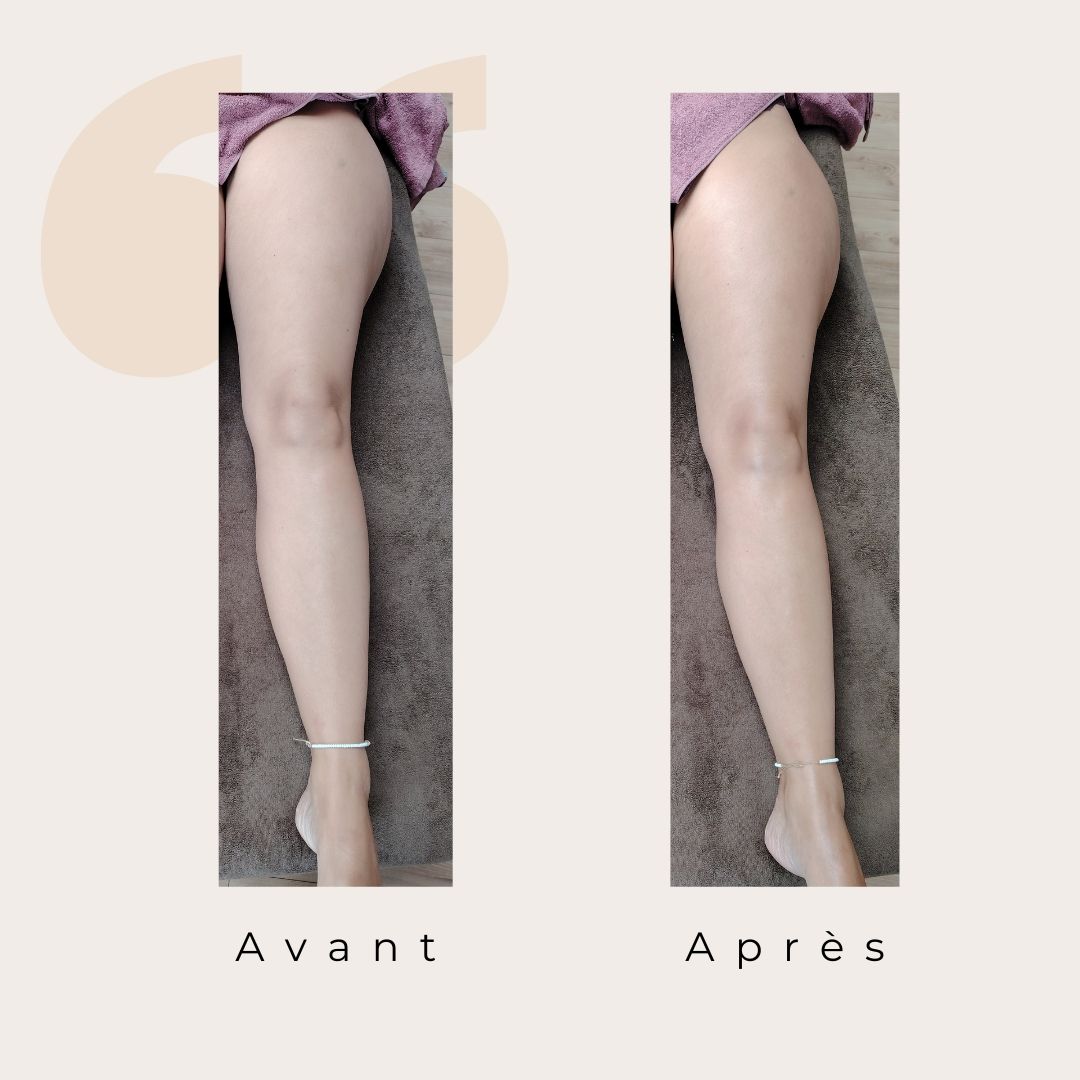 Un avant après sur une séance de drainage et madéro. Une jambe plus tonique et une peau plus lisse, mais surtout une sensation de mieux être immédiat.
#drainagelymphatiquerenata #mieuxêtre #détente #massage