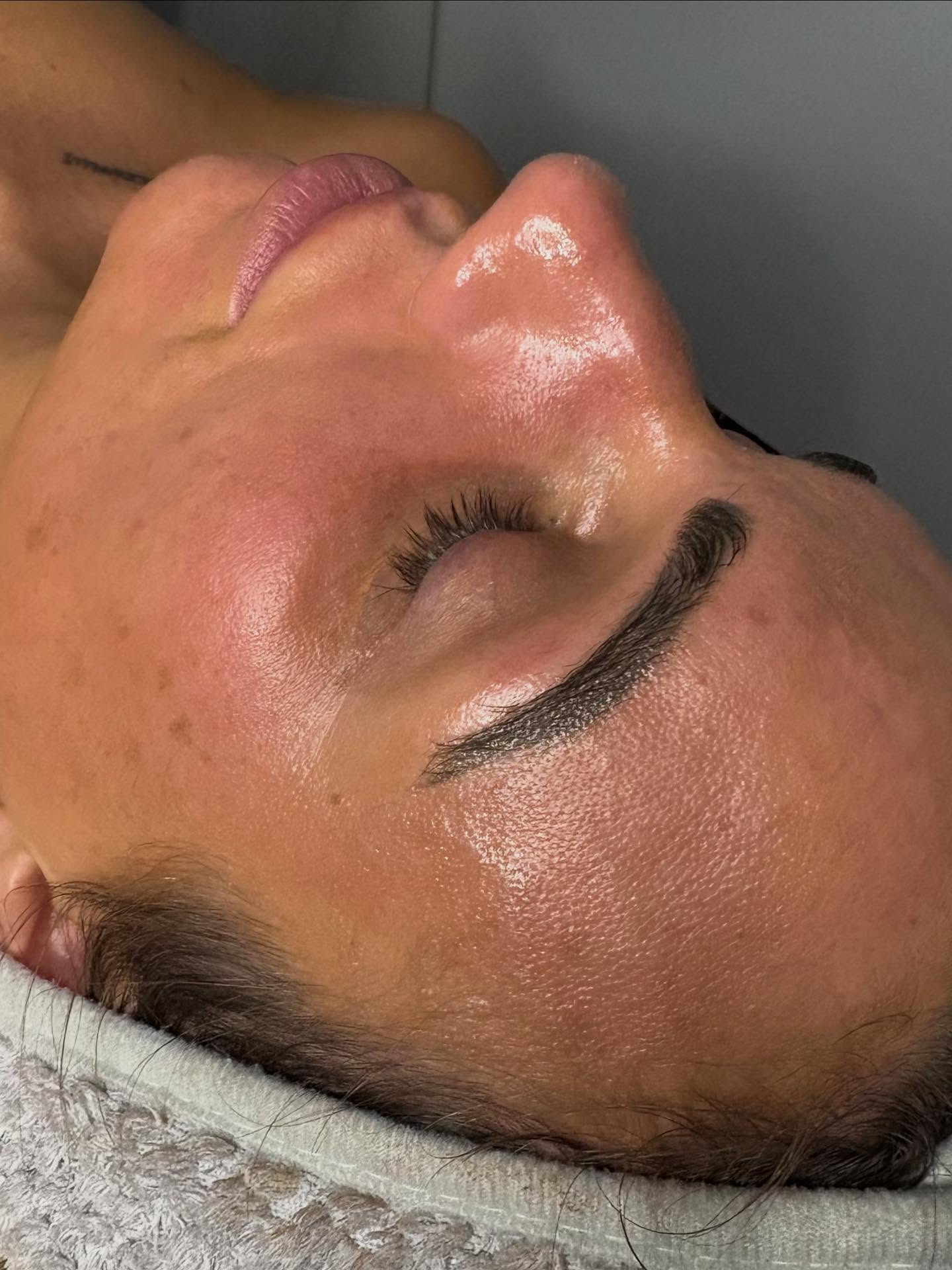 Obsessed with these SeventyHyal & BBGLOW results today 😭✨Just one of each treatment.
A perfect skincare combo to reduce signs of ageing, large pores & dark spots. While boosting collagen production & maximum hydration to the deepest layers of the skin.
20% off ALL skincare until end of Sept.
#skinbooster #bbglowtreatment #microneedling #skinboostershampshire #skinboosterssurrey #skinboostersberkshire #seventyhyal #profhilo #skin