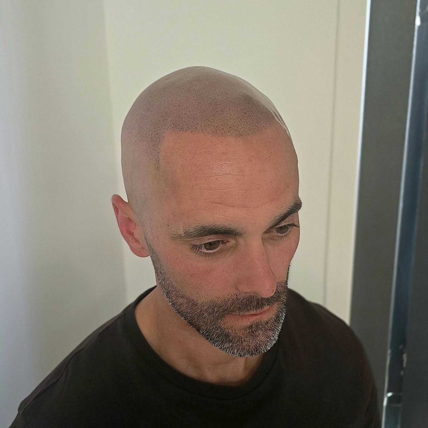 THIS IS NOT REAL HAIR!
Fresh SMP (Scalp Micro-Pigmentation)
Natural looking results;
Hairline restored
Highest quality pigment (No blue, no green hue)
Low to minimal maintenance
This clients pain rating was *2/10
No downtime
*Varies between clients
Healed photos to follow...
📍Mildenhall/Bury St Edmunds
#smp #scalpmicropigmentation #scalptreatment #hairloss #hairlosssolution #regrowhair #hairfall #hairgrowth #remedy #hair #menshair #balding #receding #hairtattoo #hairtransplant #newhair #buzzcut #shavedhead #trichology #prp #pigmentation #hairsystem #wig #hairfibres