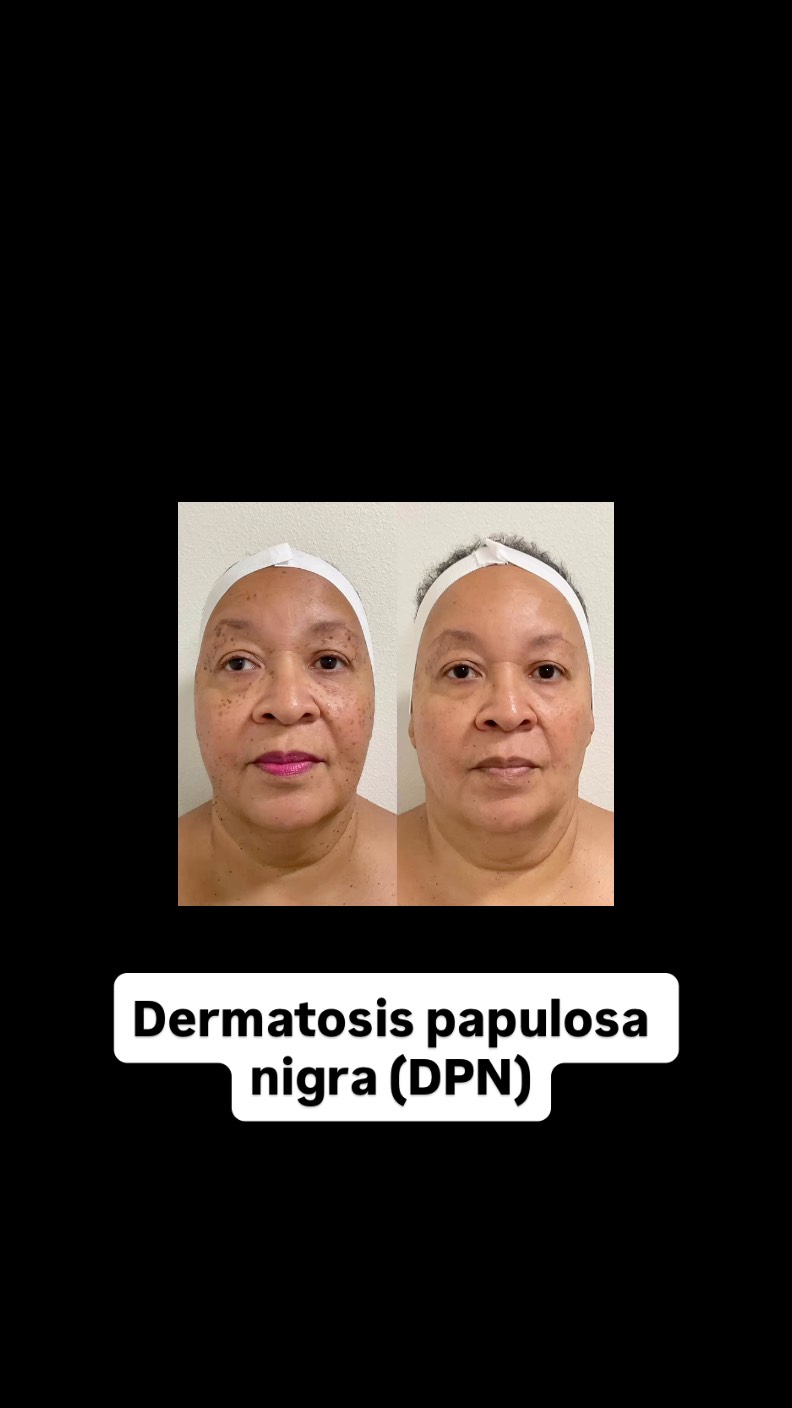 ##capricebeautybar #theskingames2024 #sarasota #hifu #age #age #skintags #siestakeybeach