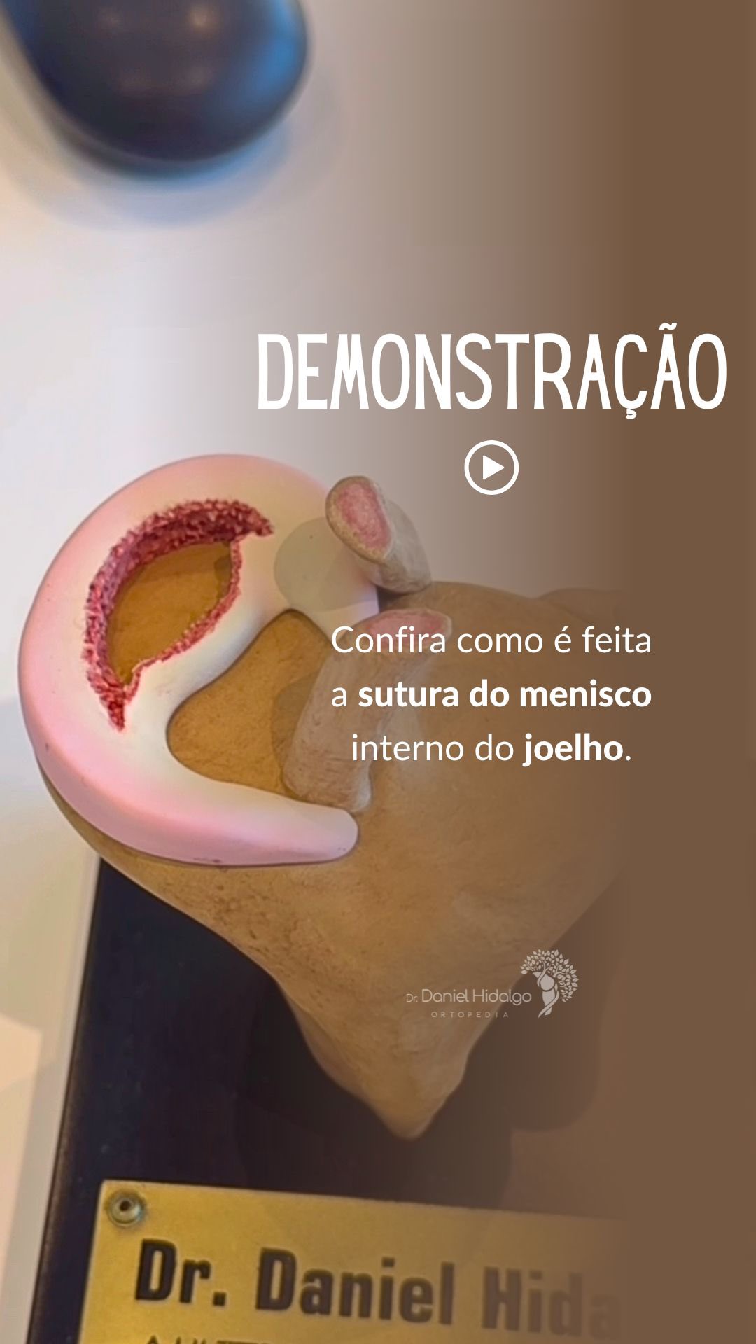 Confira como é feita a sutura do menisco interno do joelho.
#joelho #menisco #savethemeniscus