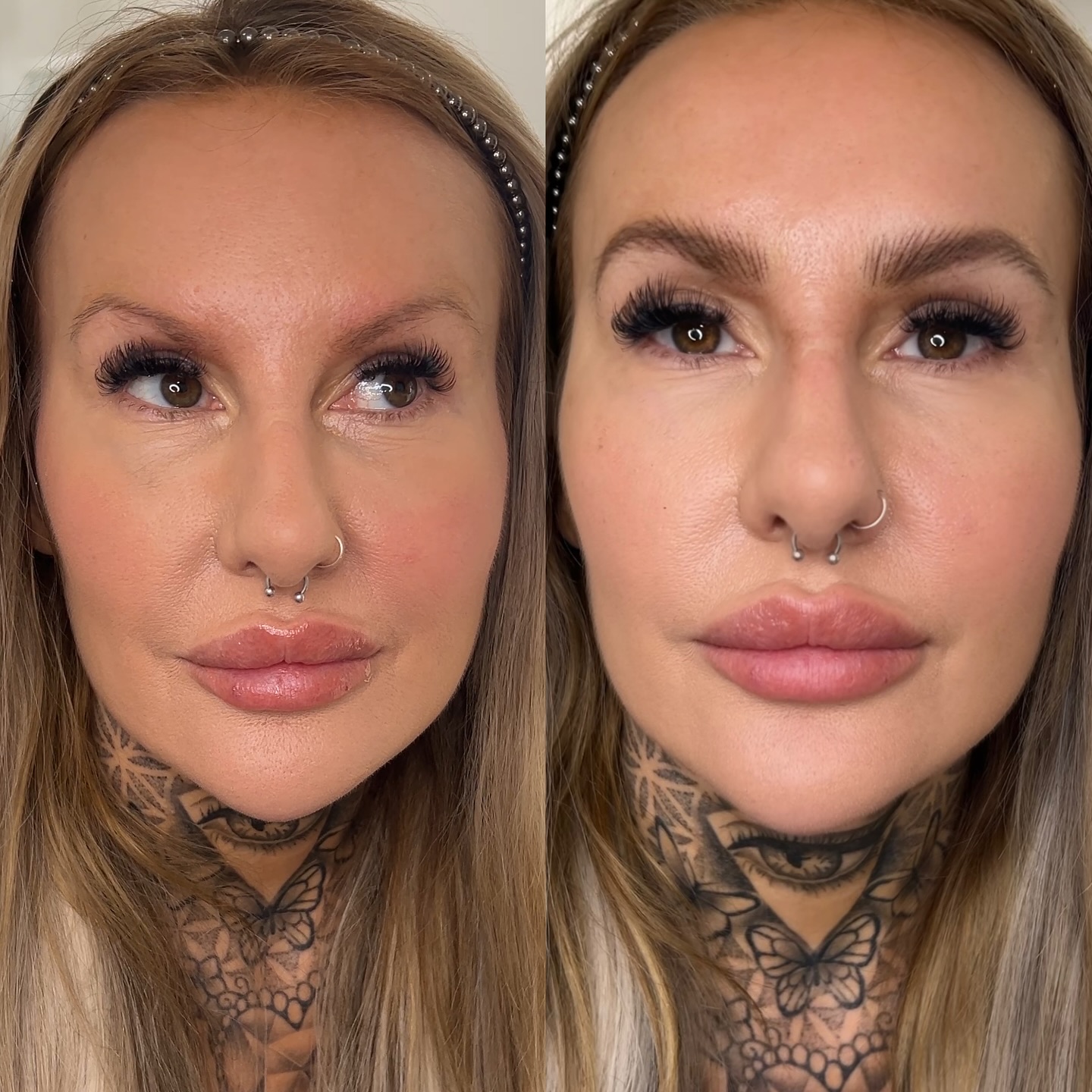 🩷 HYPER REALISM BROW TATTOO BROW GLOW UP 🧡🧡🧡🧡
Swipe for close ups. My beautiful client - inside and out had waited a long time for these brows after previously having a block dark brow and then laser sessions.
This is right after the first session, they will shrink in size and go lighter and then the second session I’ll add more depth and density and make alterations based on how her skin has healed. Hyper realism brows isn’t just a new buzz word for cookie cutter hair strokes - these are completely unique to your face and features and they are created like a drawing (my background is art not beauty) they are designed with movement and to fit with the individual way a persons real eyebrows would flow. No blocks, no templates, designed all freehand - just for you because every face is different
Two sessions are needed spaced 5-6 weeks apart. This is immediately after session 1, no redness or trauma to the skin.
I use a tiny needle and a machine to create natural and lifelike hair strokes that flow like real hairs and are personalised to your face and features.
I draw them on first so you can see the shape I recommend for your face and then I go ahead with the treatment using numbing cream
You can also find more info here on my website
https://www.jorlittle.com/permanent-eyebrow-tattoo
booking for last date in Sept and October now - so message if you’re hoping to complete your brow journey before Xmas as it takes a couple of months from start to finish and I book up quite far ahead.
What’s app me rather than call on 07976 439678 or book on my website where you can also find prices via book now page for Tynemouth & London
www.jorlittle.com
Used @@hanafy_uk pigments and @face.pm @defenderrofficial needles @id_liner_pmu @luna.cartridges @cosmedic_supplies
#hyperrealism #hyperrealismbrows #hyperrealismbrowsnewcastleupontyne #hyperrealismbrowslondon #permanentbrows #permanenteyebrows #fluffymicroblading #nanoblading #fluffynanobrows #eyebrowtattoo #eyelinertattoo