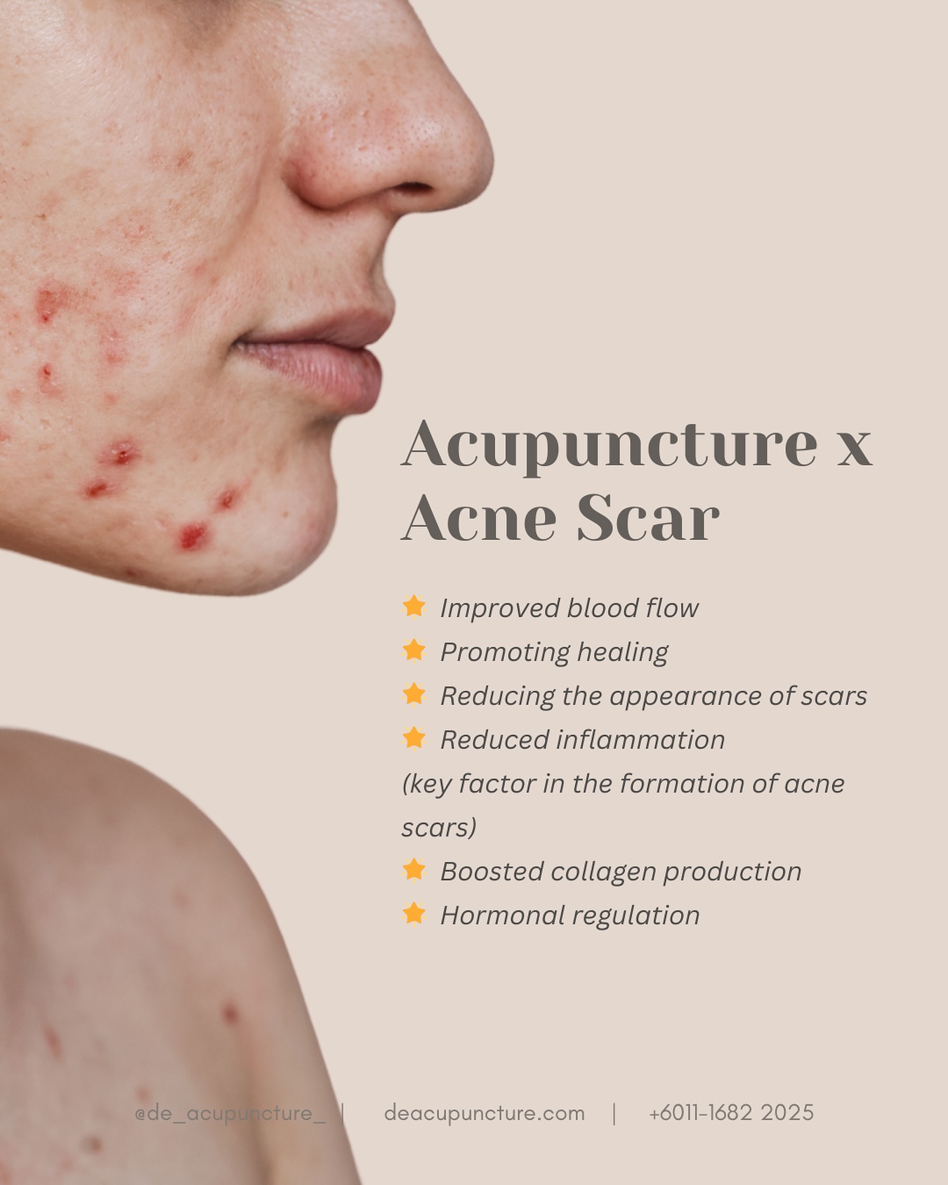Fade Away Those Scars with Acupuncture
Tired of those pesky acne scars? Acupuncture might be the solution you’re looking for!
How can acupuncture help?
💖 Boosting Collagen Production:
Acupuncture can stimulate collagen production, which helps to fill in scars and improve skin texture.
💖 Improving Blood Circulation:
Increased blood flow to the affected area can promote healing and reduce inflammation.
💖 Calming the Mind and Body:
Reducing stress can help improve skin health and accelerate the healing process.
Ready to clear your skin✨?
Consult with a qualified acupuncturist to discuss a personalized treatment plan.
📣 Remember, patience is key. Consistent treatment and proper skincare can help you achieve a clearer and more radiant complexion.
_
#traditionalchinesemedicine #中医 #tcm #wellness #health #mindfulness #selfcare #malaysia #KL #PJ #de_acupuncture_ #医心医意中医坊
#DeAcupuncturexHerbsCentre
//
👩🏻⚕️医心医意中医坊
De Acupuncture x Herbs Centre
🇲🇾Certified TCM Practitioners
📣Appointment only, no walk-ins
📍Subang Jaya USJ 1 诊所
🈺Tue-Sat 9am-6pm
☎️WhatsApp 011-1682-2025
🌐deacupuncture.com