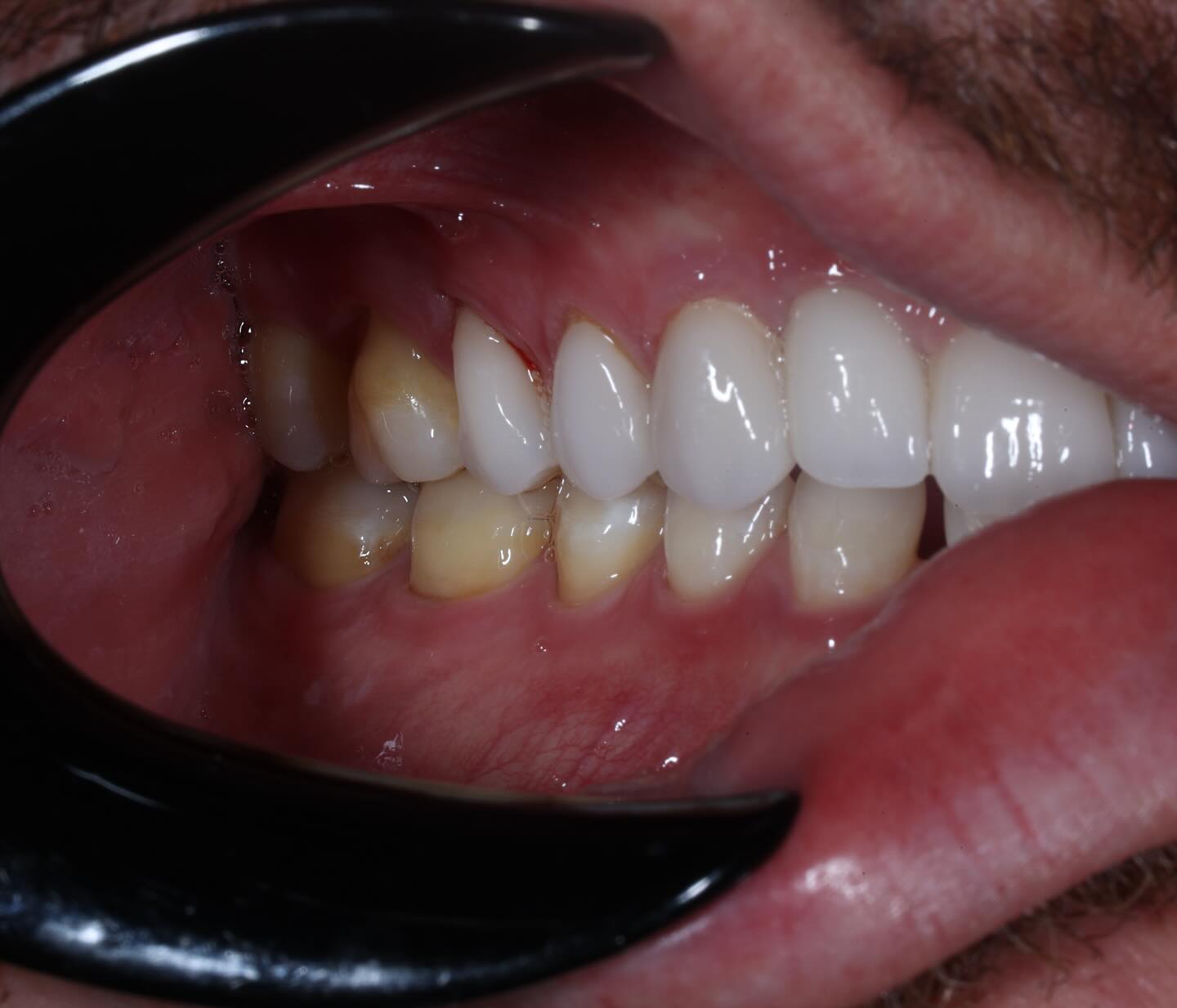 ✨ Precision matters. Vonlay on #4 stained and shade-matched for a natural look.
#DentalLab #CrownifyDental #ShadeMatch #DentalLab #CrownifyDental #DentalTechnician #DentistryWorld #DentistryLife #DentalRestorations #DentalCase #Prosthodontics #DentalCeramics #DentalArt