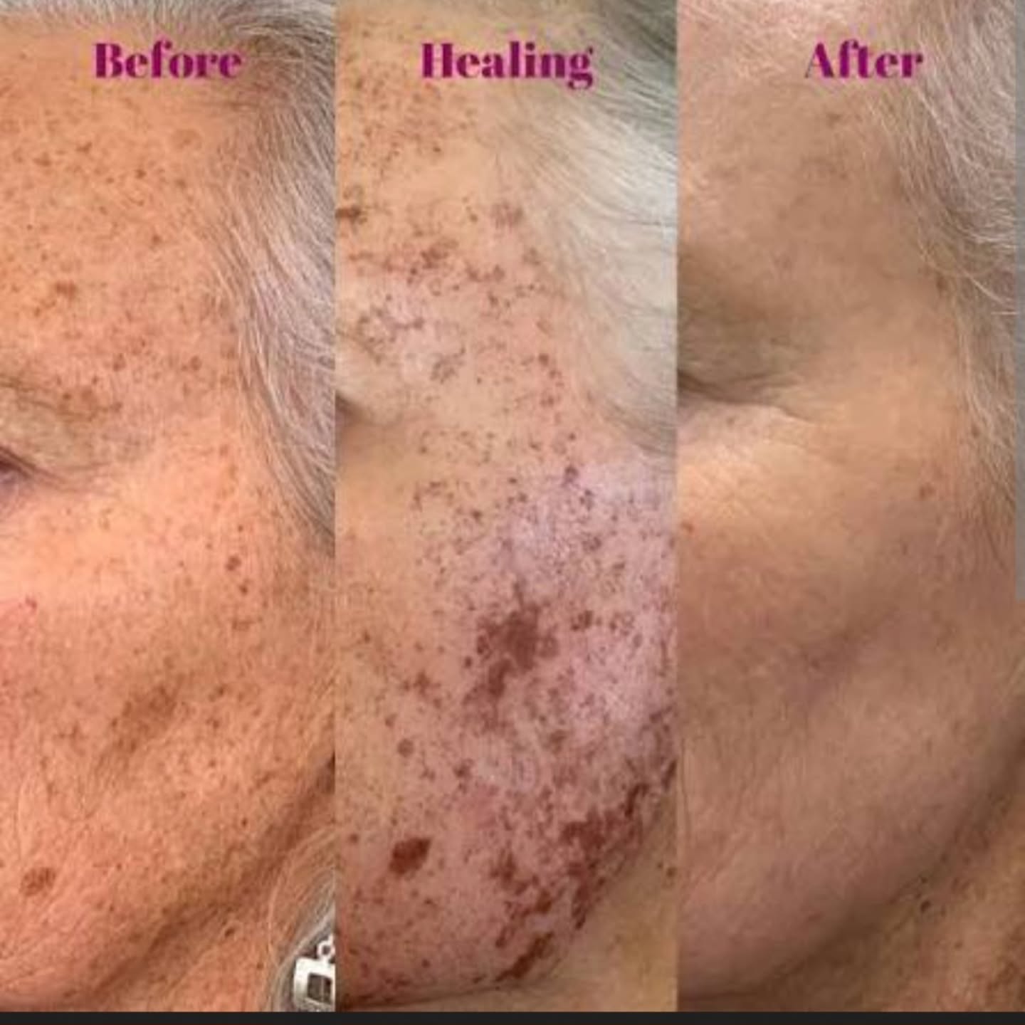 Applying LED light immediately after an IPL treatment is beneficial because it can help to reduce post-treatment redness and swelling, and accelerate healing. This is because LED therapy, particularly red light therapy, has anti-inflammatory properties that calm the skin, while also stimulating collagen and improving circulation. This combination makes it an excellent way to enhance recovery and comfort after an IPL/LASER session.
How LED Light Helps After IPL & Laser
Reduces Redness and Inflammation:
The low-energy, continuous light from LEDs helps to soothe and calm the skin, which can be inflamed and red after IPL.
Speeds Up Healing:
By reducing inflammation and boosting circulation, LED light therapy helps to accelerate the natural healing process of the skin.
Stimulates Collagen:
Red and near-infrared LED wavelengths encourage the production of collagen and elastin, which helps to firm and rejuvenate the skin.
Improves Comfort:
The calming and healing effects of the LED treatment make the recovery period after IPL more comfortable for the patient.
Following your session at your clinic, you can use THE MASK at home for continued results and keeping that inflammation down.
The Mask elevates your gomecare and in salon treatments making them more effective.