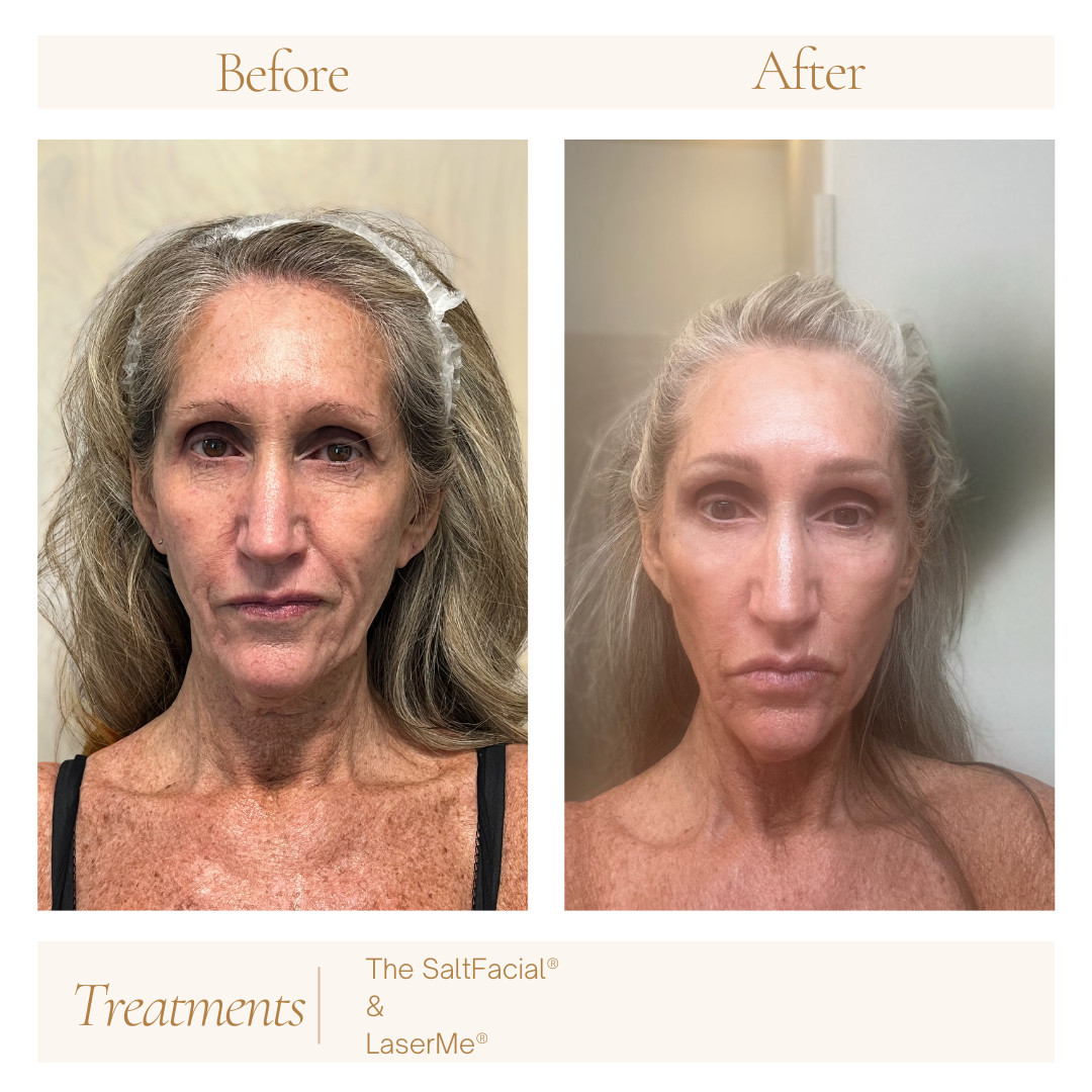 ✨ Our Client’s Results ✨
After just 3 Salt Facial + Laser Me treatments:
• Collagen stimulated, lines softened
• Hyperpigmentation lightened
• Pores smaller, skin refined
📸 Swipe to see her transformation - and this is only a few days after the 3rd treatment! Can’t wait to see the glow continue. 💫
Book your appointment now at sierramedicalaesthetics.com
