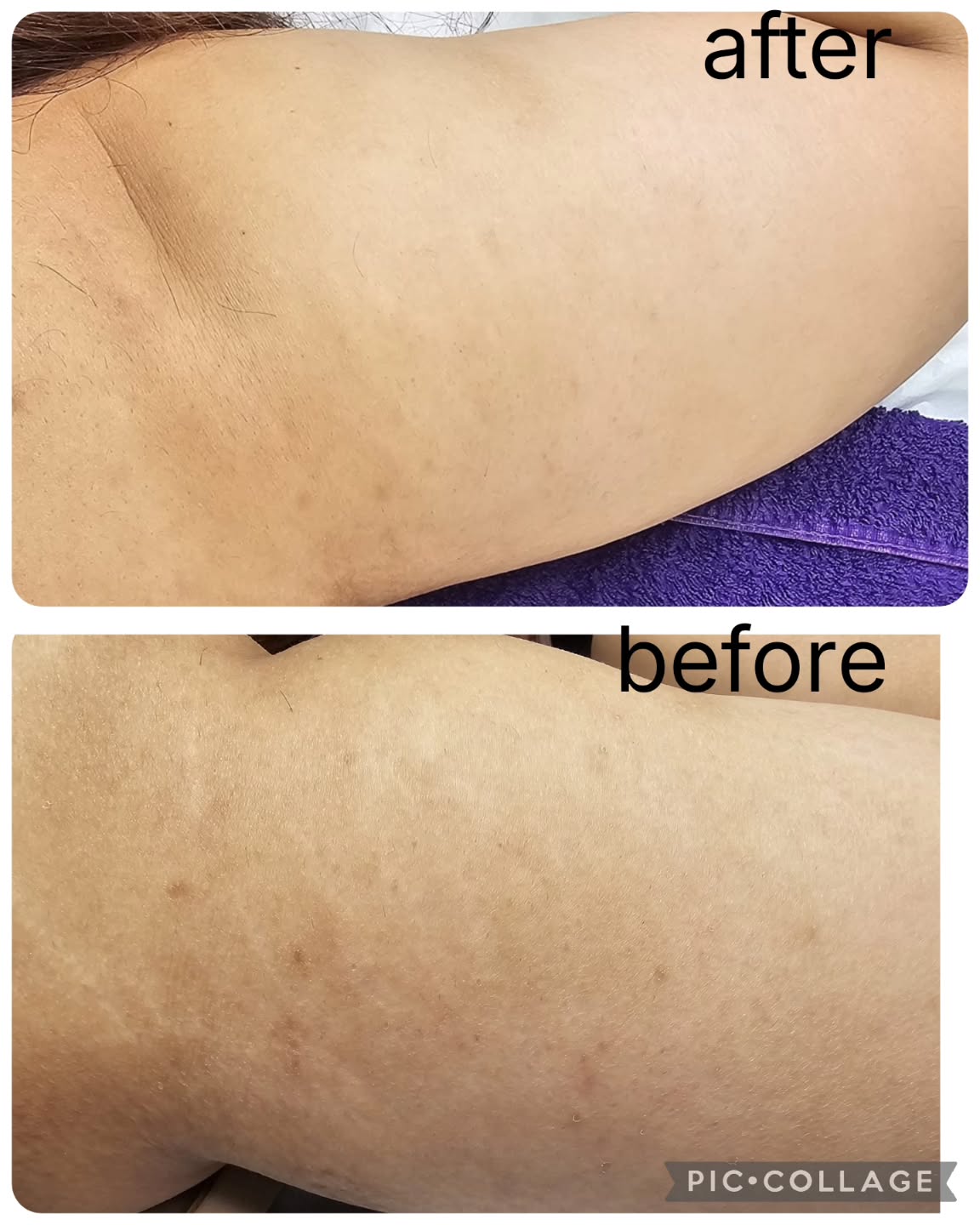 This lady came to me with visible pigmentation marks post acne as well as stretch marks on her arms. She wanted to be best version of herself for her Big Day - wedding . 👰♀️👰♀️👰♀️
Fantastic results only after 2 , @biorepeelcl3.official and microneedling.
Pigmentation and stretchmarks are a lot less visible. We can do a lot to make you feel more comfortable in your own body with the right tools. Trust your therapist ❤️