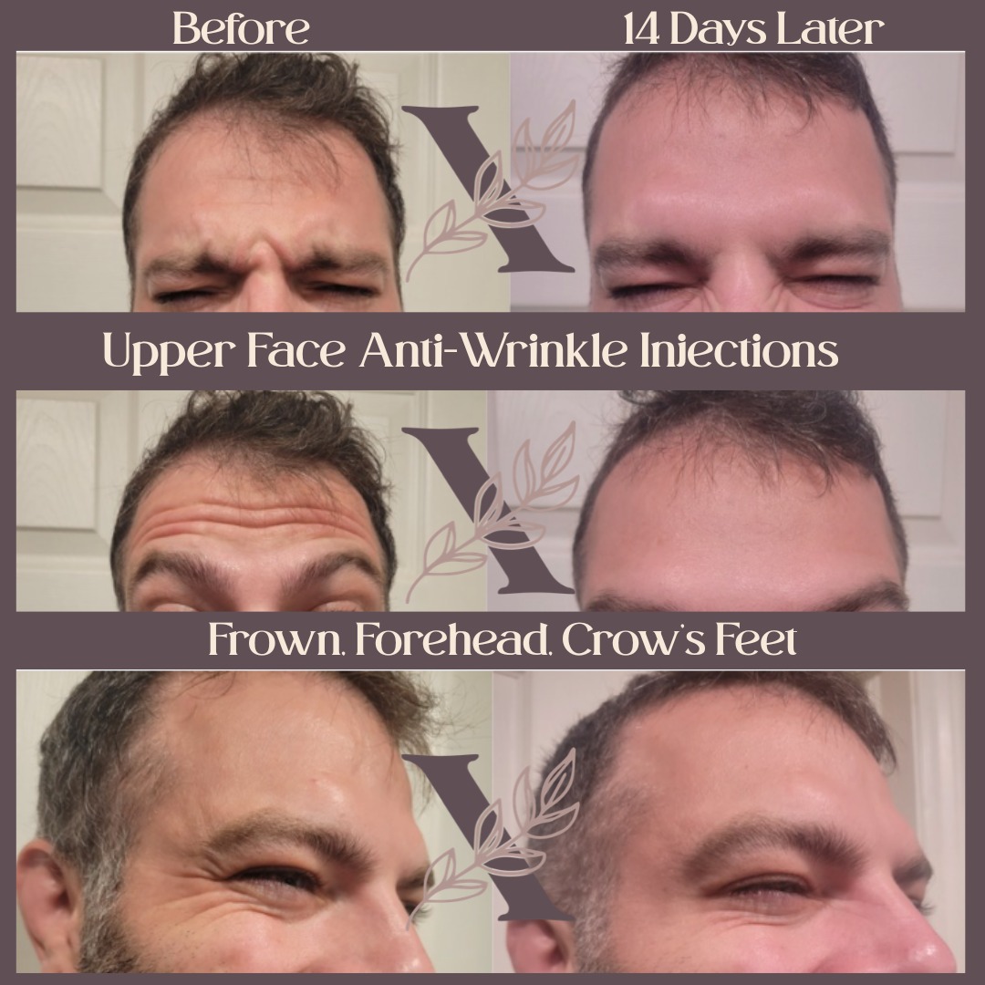 😊
Book your appointment today:
www.beautyxpressions.org
Appointment locations in Windsor and Ottawa ON
--
#botox #aesthetic #aesthetics #injectables #skincare #beauty #cosmetics #skintreatment #antiaging #wrinklesbegone #injector #botoxformen