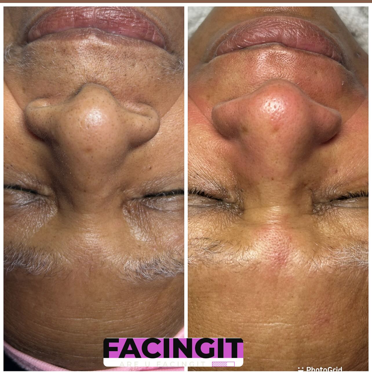 The seasons is changing & cold-weather is upon us. Remember your skin changes as well. Do your skin seems more dry, irritated, & itchy. Or maybe you see more red and white bumps or your acne or eczema it’s starting to flare up more. Book a session with me and I can help with your every needs. Book here at my website at www.aubriafacingit.com . Look over all my service and see what best fit for you. Hit the chat button online for immediate response.
Tired of dry itchy skin? Dead skin on your face?? Did you know with the seasons changing your skin will change as well! Let me help you maintain a natural balance for your skin care.
https://www.aubriafacingit.com/
The seasons is changing & cold-weather is upon us. Remember your skin changes as well. Do your skin seems more dry, irritated, & itchy. Or maybe you see more red and white bumps or your acne or eczema it’s starting to flare up more. Book a session with me and I can help with your every needs. Book here at my website at www.aubriafacingit.com . Look over all my service and see what best fit for you. Hit the chat button online for immediate response.
#dermaplaningfacials #facialatlanta #atlantaspa #atlantaskincare #clearskin #explorepage #vacuumtherapy #facials #lymphaticdrainage #collegeparkga #blackesthetician #eastpointga #Atl #beautiful #facialsatl #spaday #menfacial #dayspa #hairremoval #aesthetics #facialtreatment #blackowned #estheticianatlanta #facingit #extractions #atlanta #naturalskincare #blackheadremoved #atlantastylist #atlantahairstylist