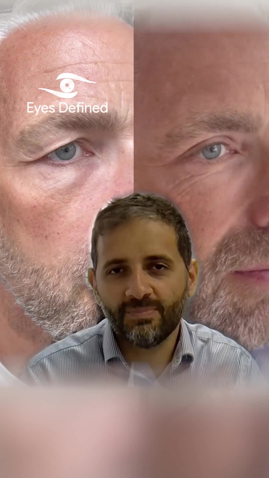 Curious if an upper eyelid blepharoplasty changes your eyebrow position? 👁️✨ In this reel, I break down what happens to the brow after surgery and what you can expect during your recovery. Understanding these subtle changes can help you make the best decision for your eyelid and brow aesthetics.
Have questions? Drop them below! 👇
#Blepharoplasty #EyelidSurgery #OculoplasticSurgery #BrowPosition #UpperEyelid #EyelidLift #PlasticSurgeryUK #LondonSurgeon #FacialAesthetics #EyeSurgery #BeautyInDetail #CosmeticSurgery #EyeLift #Oculoplastics #BrowLift #NaturalResults