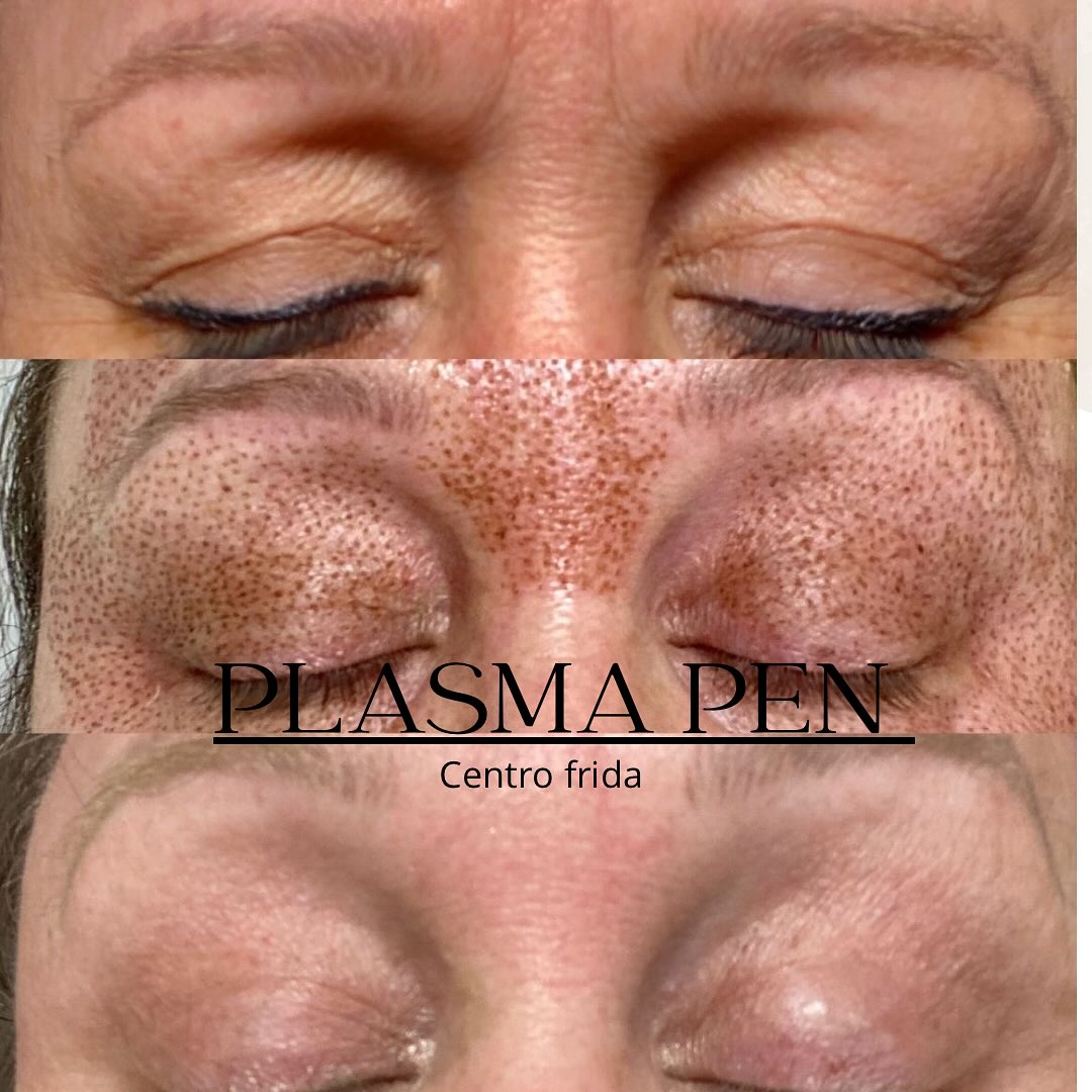 ✨ ¿Quieres rejuvenecer tu piel sin cirugía?
Con Plasma Pen es posible. 🌿
Aplicamos una cremita anestésica, así que el tratamiento es cómodo y prácticamente indoloro 💆♀️.
En pocos días tu piel estará más firme, lisa y luminosa. 🌸
📩 Reserva tu cita y descubre tu mejor versión.
📲624252194
#plasmafibroblast #plamaspen #fibroblastplasma #madrid #flacidez #arrugas #arrugasdeexpresion #centrofrida #esteticamadrid