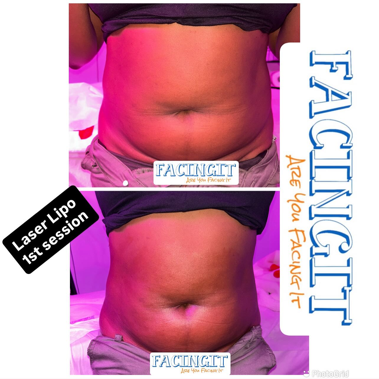 Body Contouring/body sculpting gets rid of fat cells and reduces the appearance of fat on targeted areas of the body. Whether using heat, cooling, or ultrasound, body sculpting treatments kill fat cells that are then excreted over the amount of session you encounter. See more information and pictures on on business page @_Facingit & at my website AubriaFacingIt.com
Ultrasonic or ultrasound cavitation is the use of ultrasound technology to break down fat cells below the skin. It is a non-surgical method of reducing cellulite and localized fat
Vacuum-therapy stimulates muscles and breaks down cellulite and fatty deposits, which eliminates toxins, therefore improving lymphatic drainage. Vacuum therapy also helps restore the skin’s natural elasticity to smooth the appearance of “orange-peel” dimpling in the thighs and buttocks.
CoolSculpting/ Laser Lipo is a noninvasive, nonsurgical procedure that helps to remove extra fat cells from beneath the skin. As a noninvasive treatment, it has several benefits over traditional surgical fat removal procedures.
Non-Surgical Buttock Lift is a procedure that can add fullness and shape to the backside without anesthesia or incisions & with limited pain and downtime.
〰️No Pain 〰️
〰️No downtime 〰️
〰️Safe Treatment 〰️
〰️4-8 session are advised for best result〰️
〰️Results vary depending on body type 〰️
Follow my business page @_FacingIt & check out some of my work
Website: AubriaFacingIT.com
Are You FacingIT
#facials #bodysculpting #skintightening #beauty #weightloss #laserlipo #facialsatlanta #bodygoals #cavitation #noninvasive #clarkatlanta #lipo #postoptreatment #cardi #facingit #coolsculpting #cellulitereduction #woodtherapy #minklashes #radiofrequency #facialatlanta #lasorlipo #nonsurgical #vacuumtherapy #explorepage #postop #spa #lymphaticdrainage #collegepark #bodycontouringatlanta