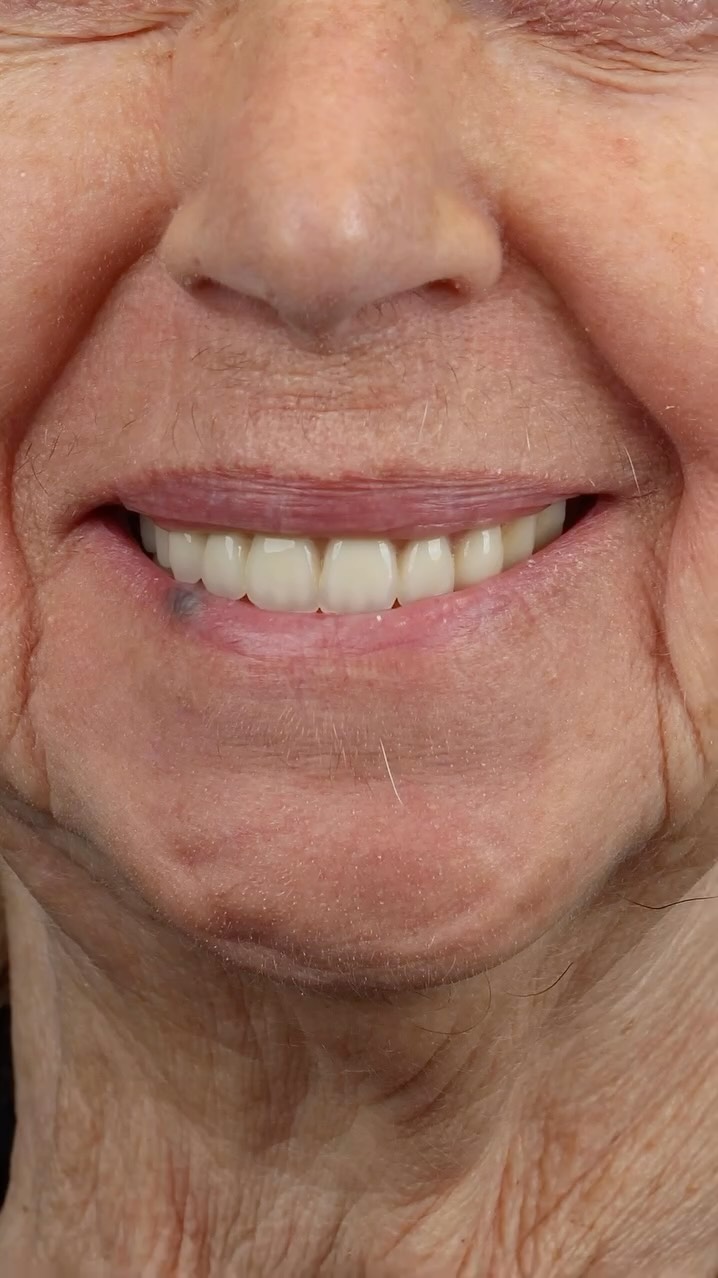 Her story: She came in with broken top teeth and just wanted her smile back.
She travels the world teaching and training, always in front of people — so having something that stays in place was a must.
We gave her snap-in implants, and now she doesn’t have to worry about dentures slipping or falling out when lecturing. What she got back wasn’t just teeth… it was her confidence.
That’s the kind of smile that changes everything.
#SnapInDentures #DentalImplants #ConfidenceRestored #ConwaySmiles
#dentalimplants #snapindentures #overdentures #orlandodentist