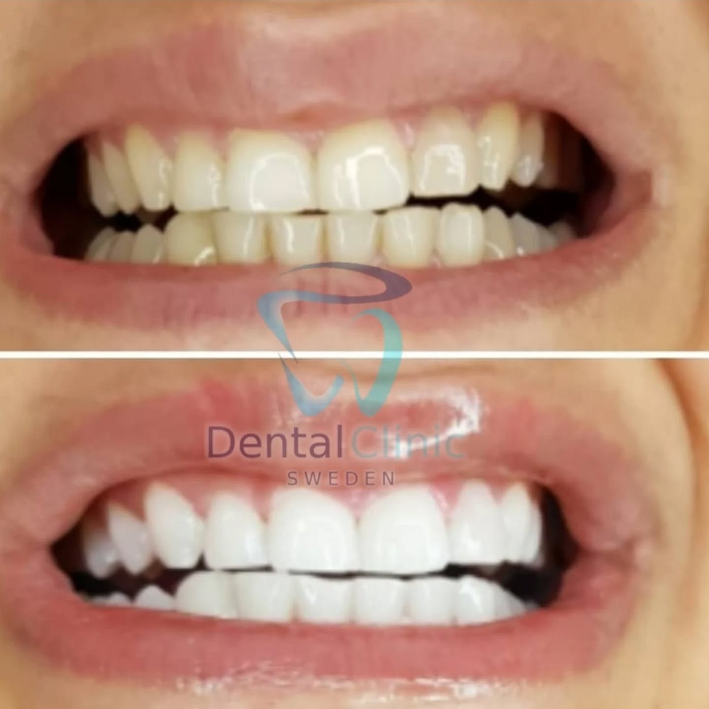 Klinik Tandblekning 
ERBJUDANDE 995 KR 
ONLINE TIDSBOKNING
www.DentalClinicSweden.org🔺️
 #tandblekningstockholm #Stureplan #Östermalm #TandblekningStockholm #tandblekning #tandsmycke #tandsmyckestockholm #stockholm #liljeholmen #KlinikTandblekning #TandblekningGöteborg #TandblekningUppsala #TandblekningUtbildning #fillers #fillersstockholm #fillersgöteborg #fillersmalmö #TandblekningsUtbildning #fillersstockholm #russianlipsstockholm