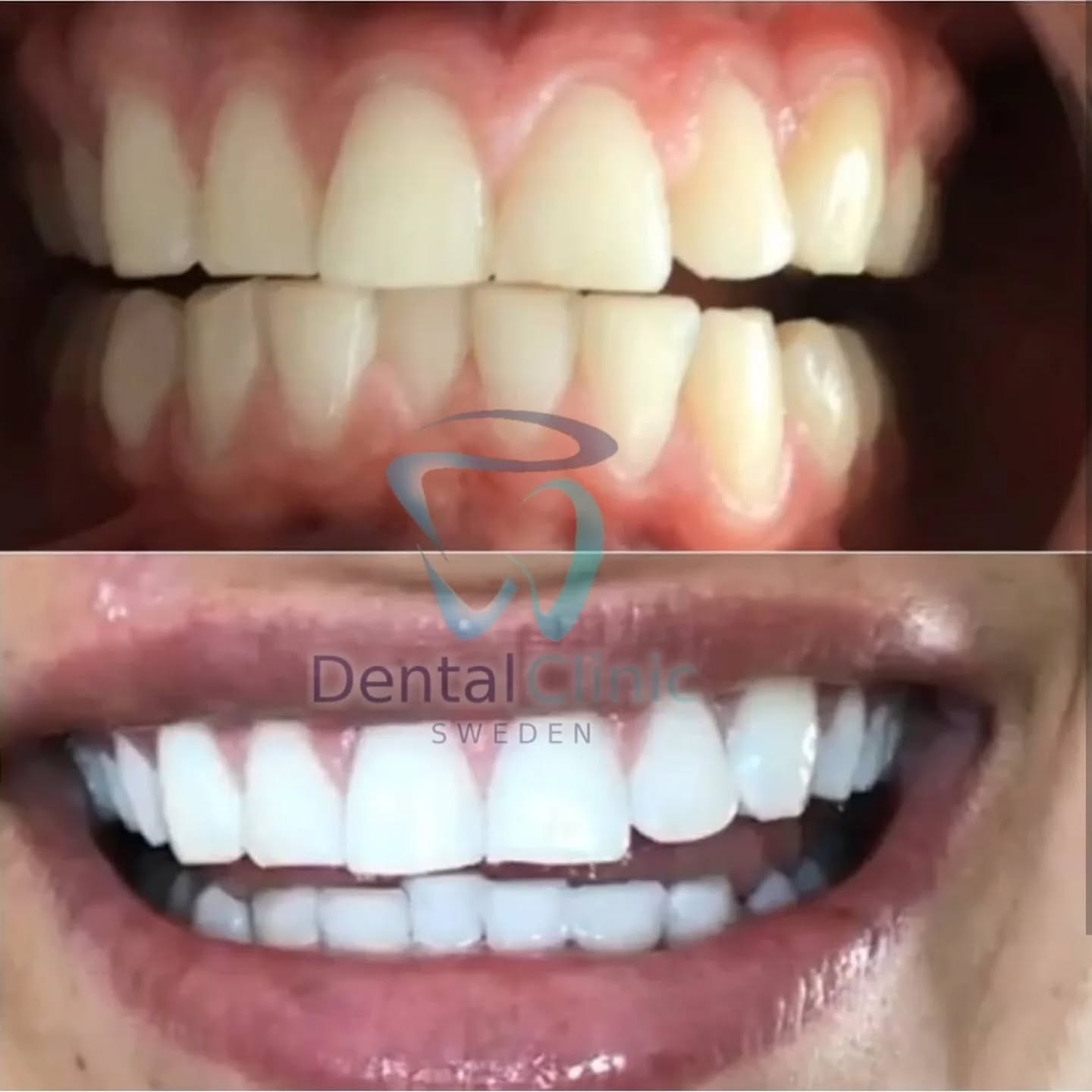 Klinik Tandblekning 
ERBJUDANDE 995 KR 
ONLINE TIDSBOKNING
www.DentalClinicSweden.org🔺️
 #tandblekningstockholm #Stureplan #Östermalm #TandblekningStockholm #tandblekning #tandsmycke #tandsmyckestockholm #stockholm #liljeholmen #KlinikTandblekning #TandblekningGöteborg #TandblekningUppsala #TandblekningUtbildning #fillers #fillersstockholm #fillersgöteborg #fillersmalmö #TandblekningsUtbildning #fillersstockholm #russianlipsstockholm