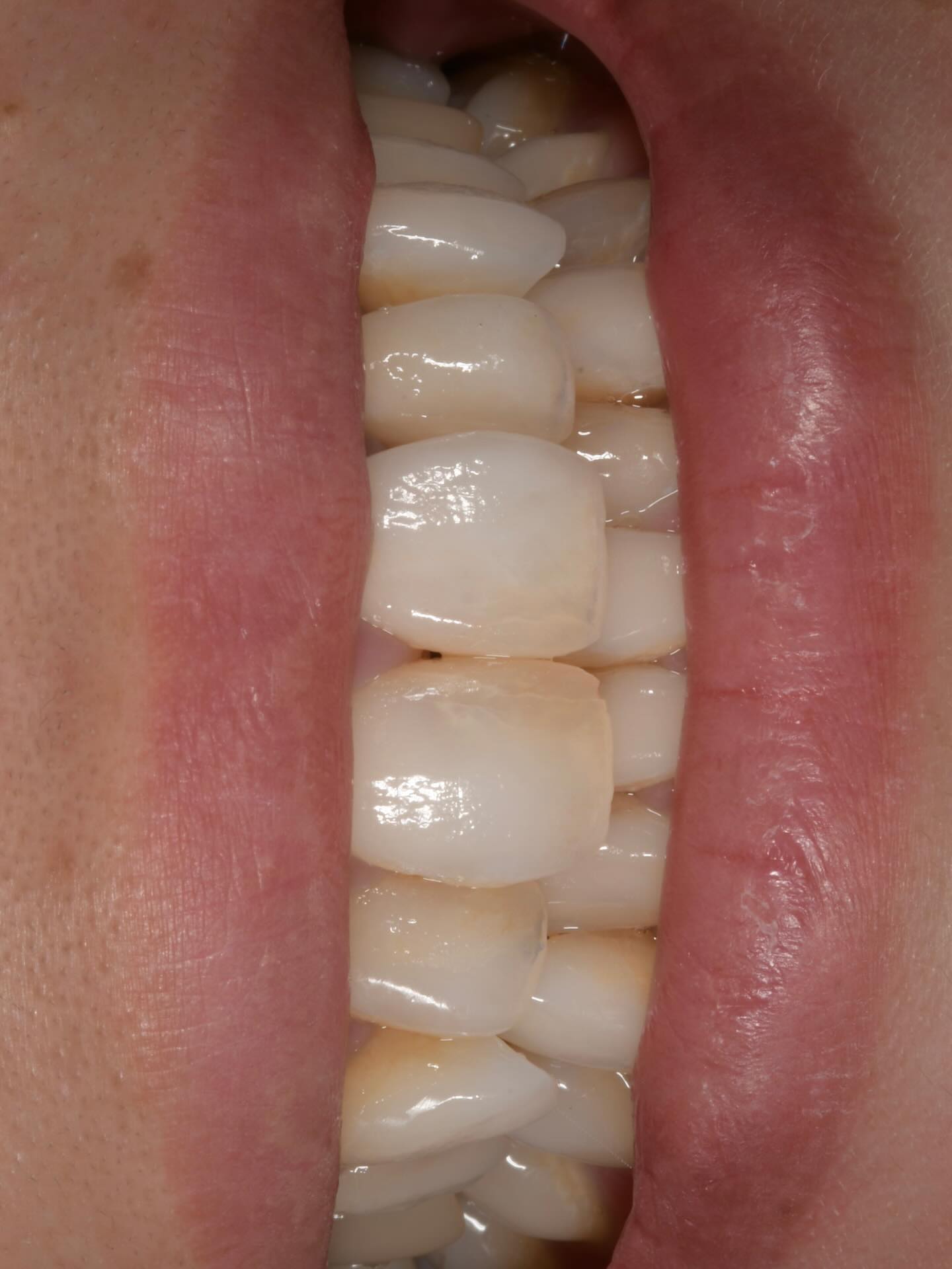 Challenge of a Discolored Abutment‼️
今日は朝からタイミングよく立ち会えたの