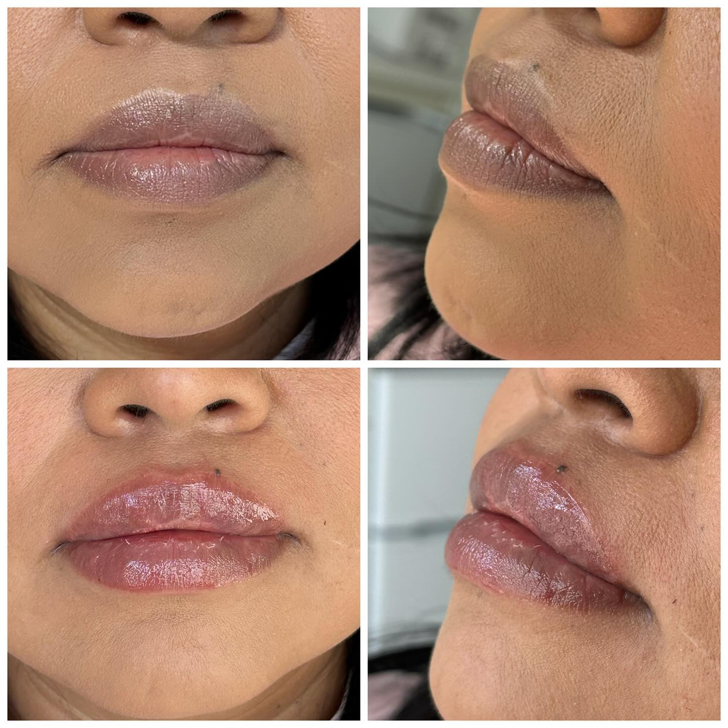 ✨Subtle enhancement, Beautiful results ✨
Transform your look with a mini lip filler treatment. Perfect for adding natural volume and hydration 👄leaving your lips, looking plump and gorgeous!
📆 Book your appointment today
📲971-375-6381