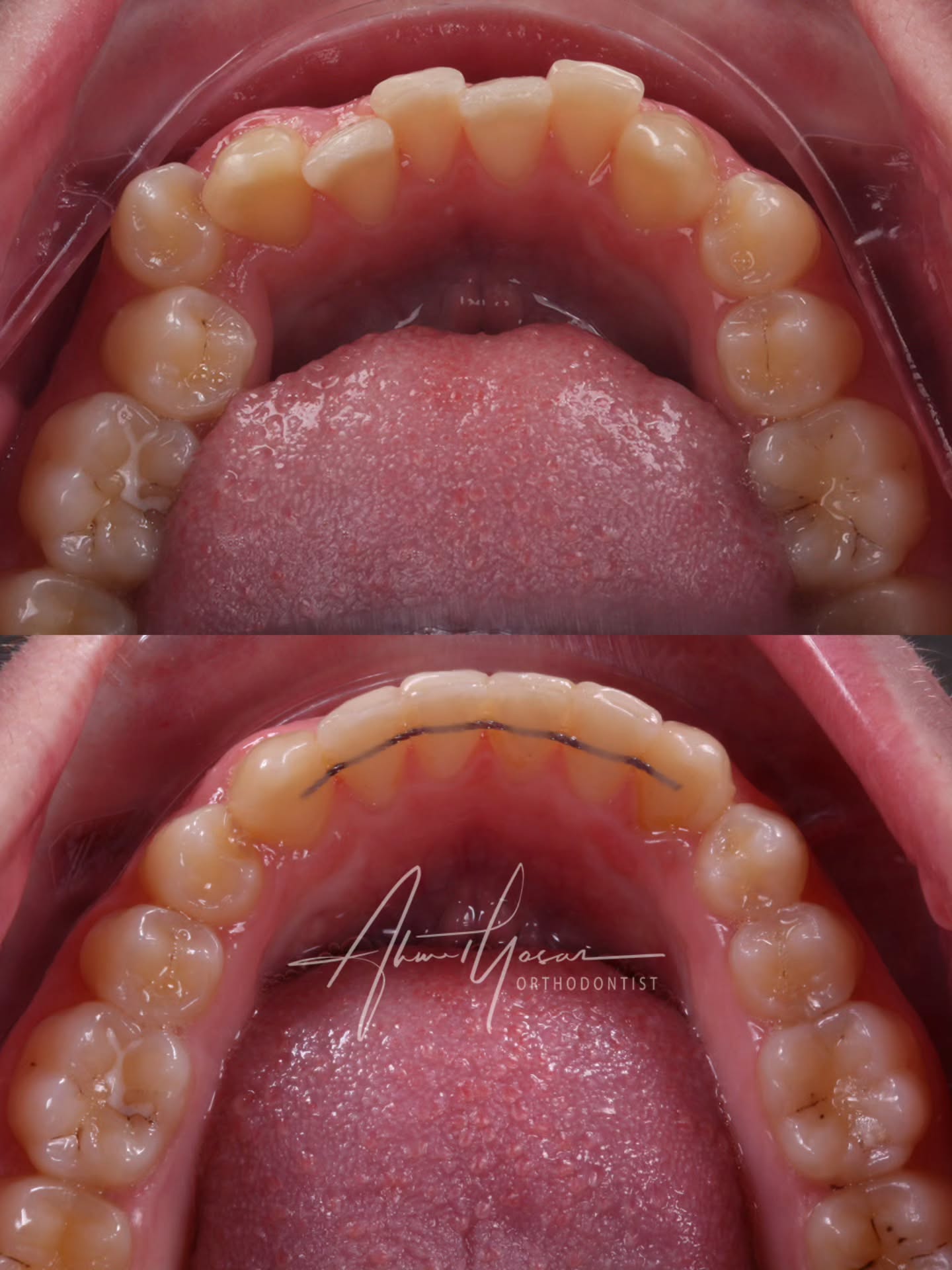 Şeffaf plak tedavisi ile alt çene çapraşiklığının düzeltilmesi.
Ortodontik tedavilerden sonra dişlerin tekrar bozulmasının engellenmesi için çoğunlukla lingual retainer ve essix plak uygulamak gerekebilir.
.
Our clinic is authorized by the Ministry of Health of the Republic of Türkiye for International Health Tourism. All patients have been informed and have provided consent for the use of their photographs on our social media platforms. All content shared on social media is intended to inform patients about procedures and should not be perceived as advertising. Outcomes of any surgical or interventional treatment may vary from person to person. It is recommended to consult your physician for detailed information before undergoing any procedure.
.
.
.
#ortodonti #ortodontist #bursa #bursaortodonti #bursaortodontist #bursaortodontiuzmanı #orthodontics #braces #teltedavisi #dişteli #orthognathicsurgery #invisalign #diş #şeffafplak #lingualortodonti #dişteli #çeneameliyatı #selfligating #kapaklıbraket #gülüştasarımı #dişhekimi #dentistry #photography #estetik #dentalart #ahmetyasar #drahmetyasar