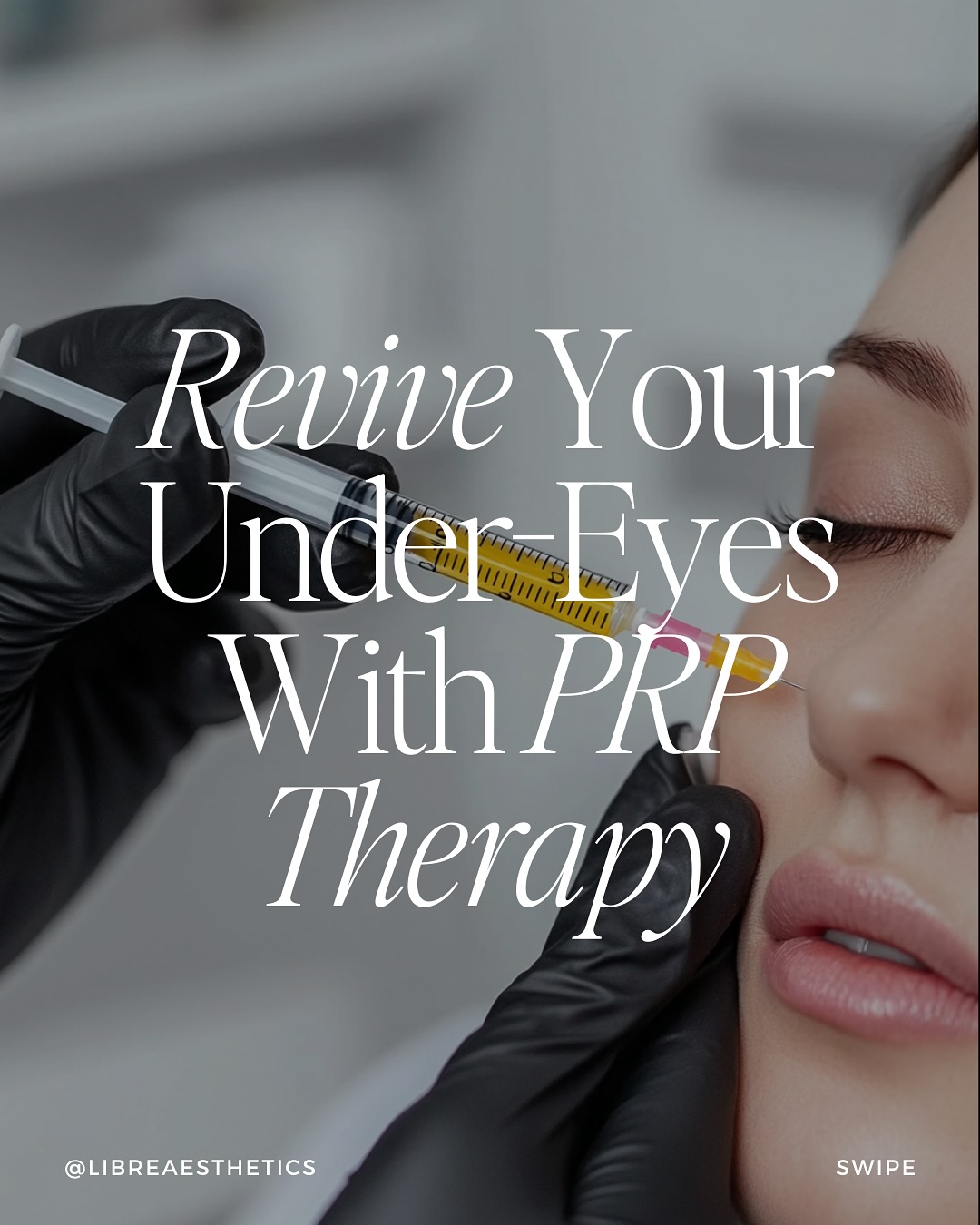 Looking a little tired? Let’s turn that around! 👀✨
PRP therapy is like a reset for your under-eyes and helps by fading dark circles, smoothing fine lines, and reducing puffiness, all with your body’s natural healing power.
The results? Fresh, natural, and effortlessly glowing. Ready to try PRP? Let’s talk, schedule your next consultation at Libré! ❤️
#prptreatment #wheaton #naperville #oakbrook #glenellyn #facial