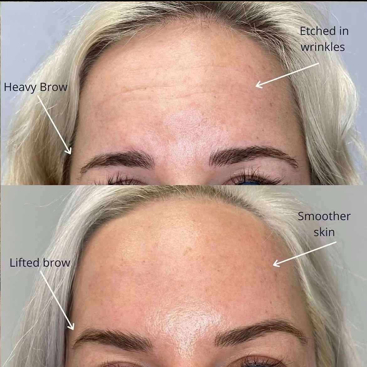 Inner beauty is everything… but let’s be real — a little Botox never hurts 😉
It’s amazing what a touch of treatment can do! These stunning results are just 2 weeks post-Botox, and my clients are absolutely glowing
✨ Smooth, refreshed, and naturally radiant — just the way it should be.
Whether you're looking to soften fine lines, prevent deeper wrinkles, or just refresh your overall look, Botox is a subtle but powerful way to enhance your natural beauty. No frozen faces here — just confident, wrinkle-free skin that still looks like you, only more rested and radiant.
Thinking about starting your own Botox journey? I’m here to guide you every step of the way — from consultation to aftercare. Let’s make your glow-up happen.
📍Serving clients in Burlington, Oakville and surrounding areas.
💌 DM to book your consultation or ask any questions!
✨ Real results. Real confidence. ✨
#Botox #BeforeAndAfter #BotoxResults #Tox #BotoxNurse #BotoxInjector #FlawlessSkin #WrinkleFree #GlowUp #burlingtonontario #oakvilleontario #OntarioInjector #el11vnbeauty #nursemel #beforeandafterbotox