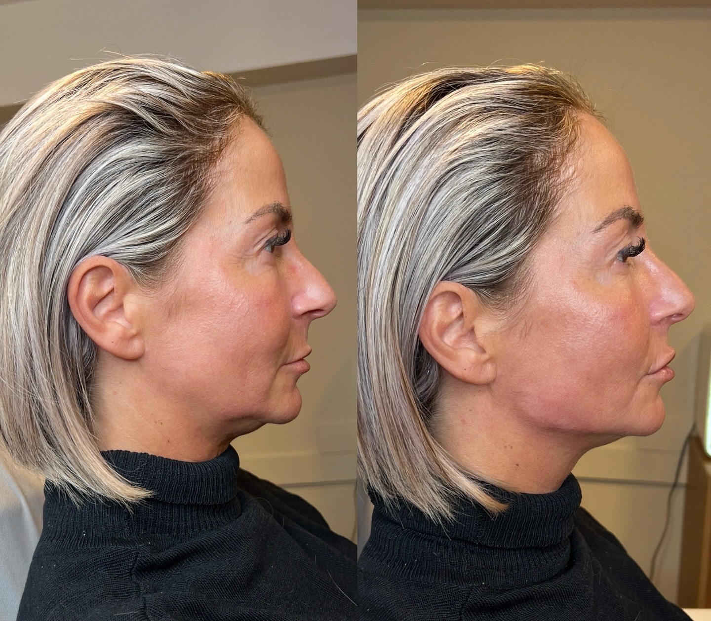 Transformez subtilement votre profil : une mâchoire plus nette, sans chirurgie. voir le résultat avant/après.
Résultat : naturel, modulable, réversible selon protocole.
2ML min sont nécessaire pour avoir un beau résultat.