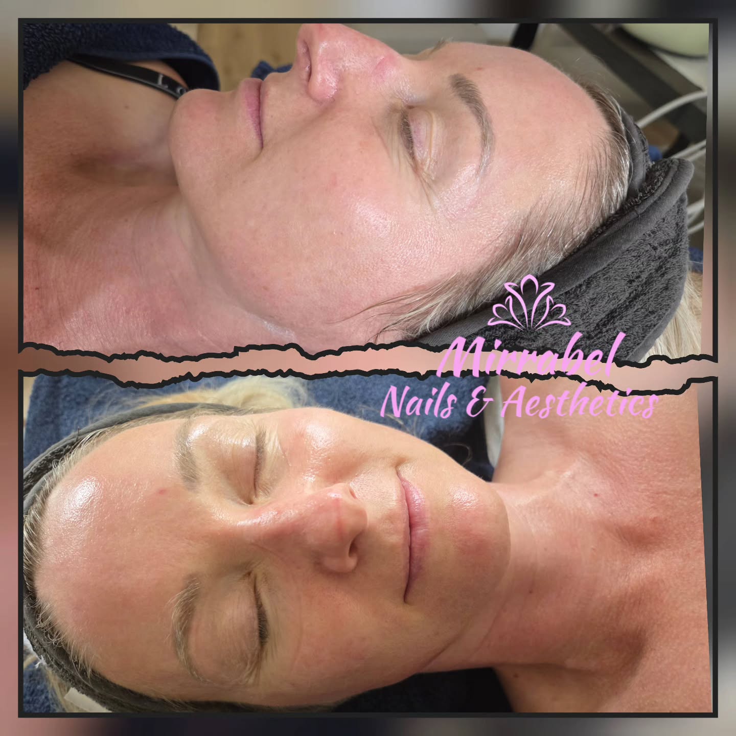 ⭐️GLOWING SKIN with HYDRO ULTIMATE FACIAL ⭐️
Rejuvenate your appearance and start fresh with healthy skin.
Hydro ultimate facial offers numerous benefits for skin, including deep cleansing, exfoliation, hydration and improved texture. It can help with issues like clogged pores, fine lines, wrinkles, and uneven skin tone, ultimately promoting a healthier, more radiant complexion.
#hydrofacial
#Altrinchamtoday #Hale #facialtreatment #skin #cloggedpores #dryskin #glowingskin #Wythenshawe