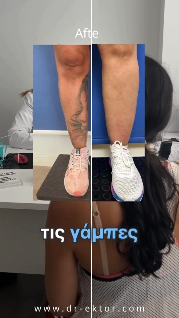 📌 Calf Liposuction for Lipoedema Relief
«Όλοι οι γιατροί μου είπαν πως στη γάμπα δεν γίνεται τίποτα.
Ο Δρ. Χατζηπαναγής απέδειξε το αντίθετο… και μου άλλαξε τη ζωή.»
✨ trust – expertise – transformation ✨
🖋 A signature result, only by DrEktor.
📍 Athens | Limassol | Nicosia
GR ☎ 210 7258982
CY ☎ 96 444870
📧 info@perfect-blue.com
🌐 www.dr-ektor.com
📲 DM us to schedule your consultation
⭐Only @drektor
#liposuction #lipoedema #calfcontouring #drektor #snatchedbbyektor #aestheticprecision #luxurysurgery #bodytransformation #beforeafter #kolonaki #athens #nicosia #limassol