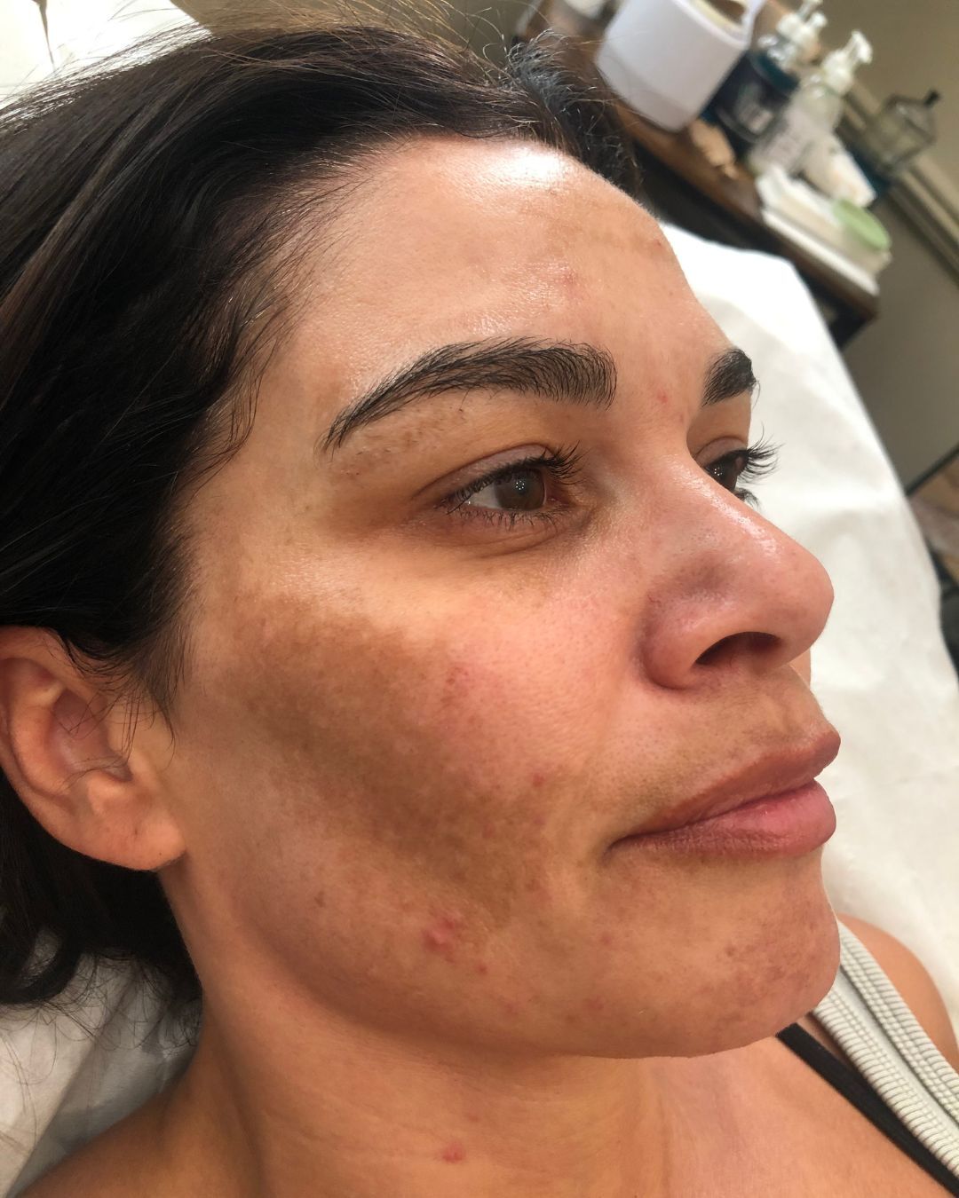 Looking to treat acne scars or hyperpigmentation concerns? The Expert Skin Clinic offers a range of skin rejuvenating treatments to boost your confidence.
Microneedling, skin peels and LED light therapy are all fantastic options for the dark marks, scarring and redness often associated with acne troubles.
Microneedling 💉 - stimulates collagen and skin renewal which is particularly effective for dullness, scarring and texture concerns.
Skin Peel 🌟 - provides a deep cleanse by removing dead skin cells to reveal a smoother, brighter complexion and a reduction of acne scars, hyperpigmentation and large pores.
LED Light Therapy 💡 - excellent for targeting the bacteria that causes spots, as well as redness, inflammation and scarring.
Swipe to see this client's amazing results following a number of treatments with us for acne, pigmentation and sculpting🤩 She had a particular type of pigmentation called melasma which we were able to significantly improve after 6 treatments, spaced 4 weeks apart.
Book in for a consultation to discuss the perfect treatments to suit your goals!