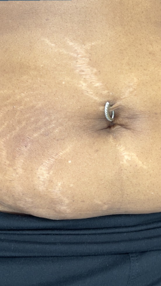 Our Inkless Stretch Mark Camouflage Revision Treatment is ideal for anyone wanting to visibly improve the texture and appearance of unwanted stretch marks.
If you have stretch marks from weight gain or loss, pregnancy, or weight lifting we are here to help @beatandblade.
Send us a picture of your treatment area or book a Consultation so that we can create a customized plan for you. #stretchmarks #beforeandafter #bikini #transformation #fyp
BEATANDBLADE.COM
Enhancing Lives One Image At A Time ™️
BEAT & BLADE
📍Houston, TX
(832) 377-5677
info@beatandblade.com
www.beatandblade.com