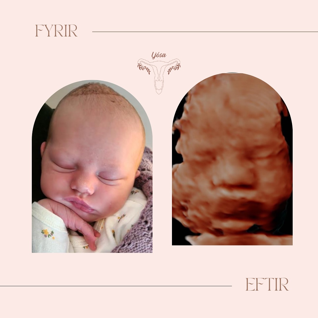 Nýjasta vinkonan, var nú ekki sú samstarfsfúsasta í sónar og elskaði að kúra sér alveg upp við mömmu sína 🤍🤍