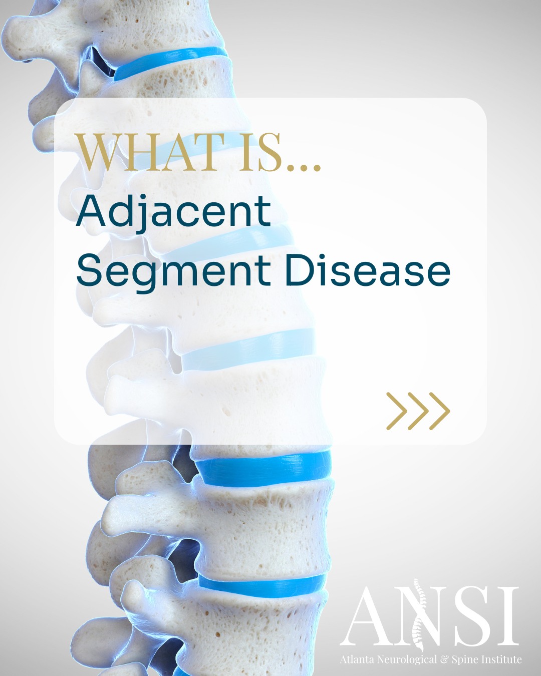 Adjacent Segment Disease can happen after a spinal fusion.
When one level of the spine is fused, the segments above or below take on extra stress â and over time, they may begin to degenerate.
Common symptoms include back pain, stiffness, or nerve irritation near the previous surgery site.
Early evaluation is key to managing pain and preserving mobility.
.
.
.
#WednesdayWisdom #ANSI #AtlantaSpineExperts