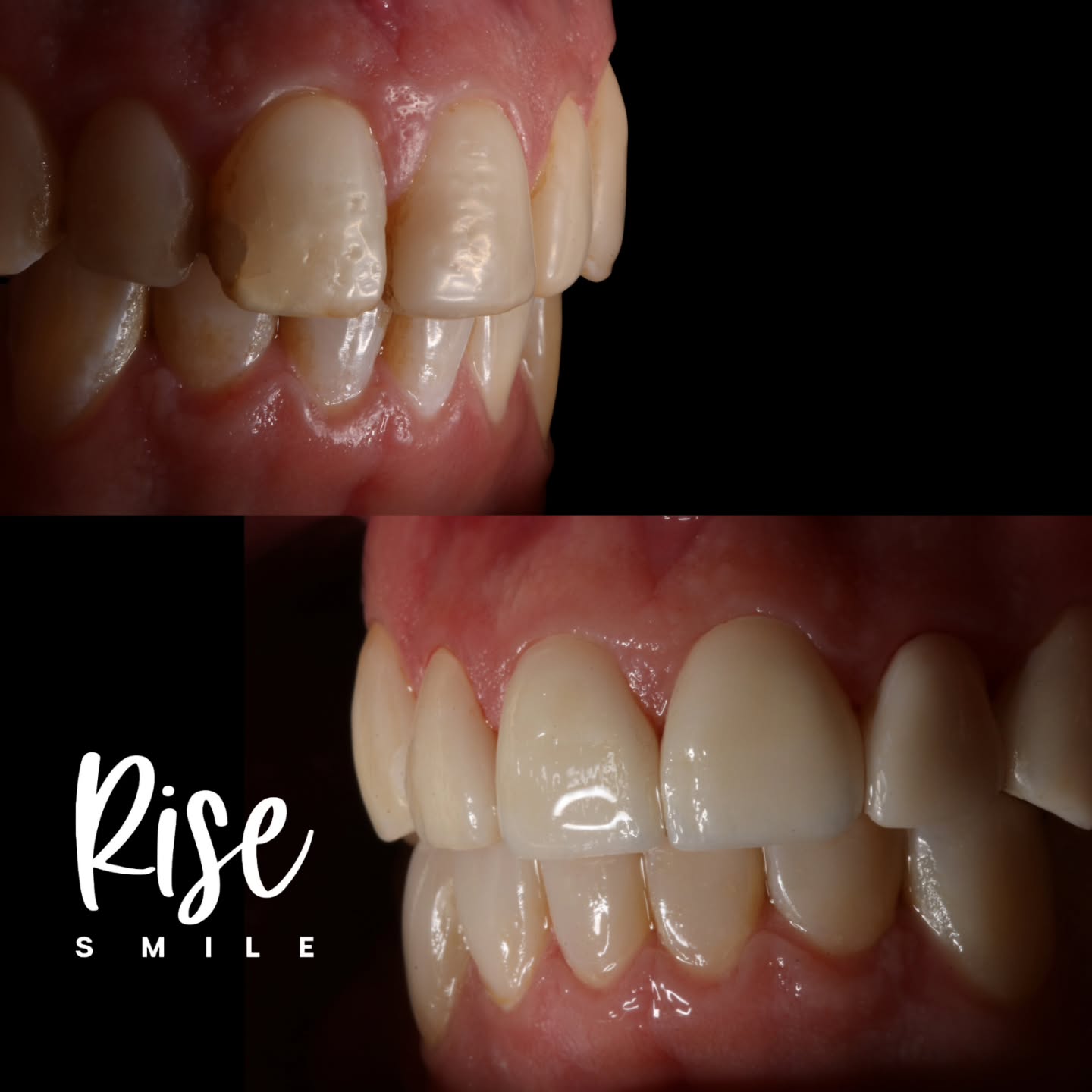 06 Carillas Porcelana
Disilicato de Litio, mínimo desgaste.
Corrección estética de forma color y posición dentaria, planificado para un resultado de aspecto saludable y natural.