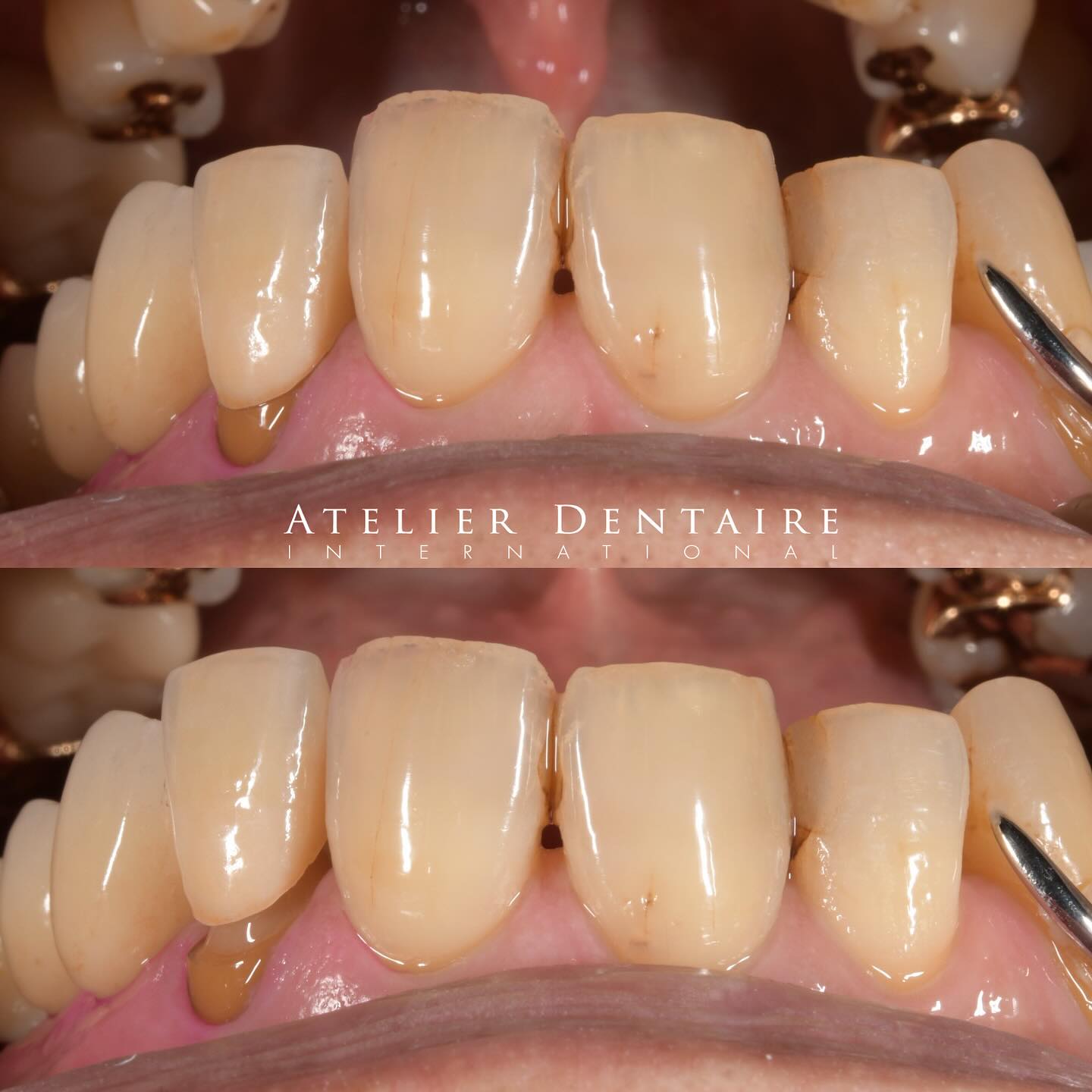 PFZ
セット立ち会わせていただきました🙇♂️
ありがとうございました。
・
・
・
・
・
・
・
・
thanks
@ivoclar
@marat_matisse.ai
@atelierdentaire.international
#dentaltechnician #zirconiacrown #pfz #emaxceram #emaxpress #審美歯科#ivoclarvivadent #歯科技工士 #静岡歯科技工所#prosthodontics #trios#odontologia #stomatolog #zahnarzt #歯科衛生士#dental #歯科医師#dentalphotography #沼津市歯科#dentist #стоматология #Dişhekimi#歯を作ってる人 #protetikazuba#singlecentral#straumann#歯科技工所#シェードテイ