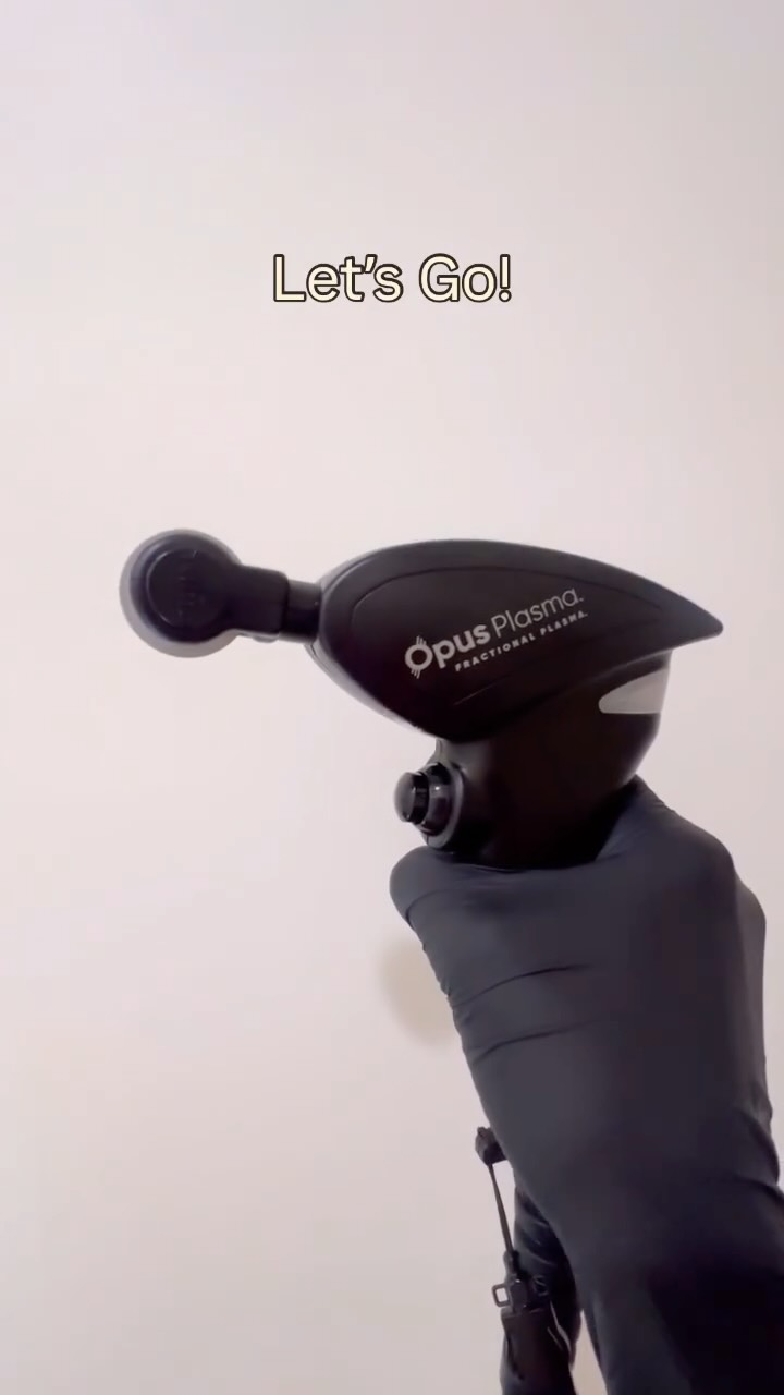 The Opus RF treatments are really starting to take off at Bare Beauty and we are seeing some fantastic results.
Did you know we can combine Opus with Exosomes to minimise downtime and boost results even more?!
Book in a consultation now to find out what this amazing machine can do and keep an eye on our page for a new eye treatment combo coming soon 👀
#barebeautybrisbane #bulimba #bulimbaskinclinic #opus #opusradiofrequency #skintightening #acnescarringtreatment #eyetreatment #asceexosomes #exosomes