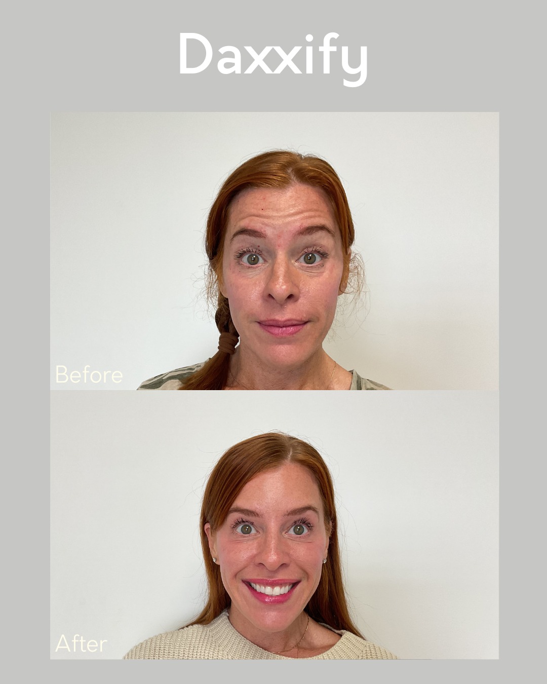 ✨ Smooth, refreshed, confident ✨
Our patient’s before & after with Daxxify® is all about softening expression lines while keeping natural movement.
💉 Forehead Lines: 20 units
💉 Glabellar (11’s): 20 units
💉 Crow’s Feet (Lateral Canthal Lines): 30 units
The result? A younger, brighter look that still feels authentically you.
📍 Cincinnati Plastic Surgery – Cincinnati’s choice for advanced injectables.
📞 513-469-0300
🌐 www.CincinnatiPlasticSurgery.com
#Daxxify #BeforeAndAfter #CincinnatiAesthetics #SmoothSkin #CincinnatiPlasticSurgery #Medspa #PlasticSurgery