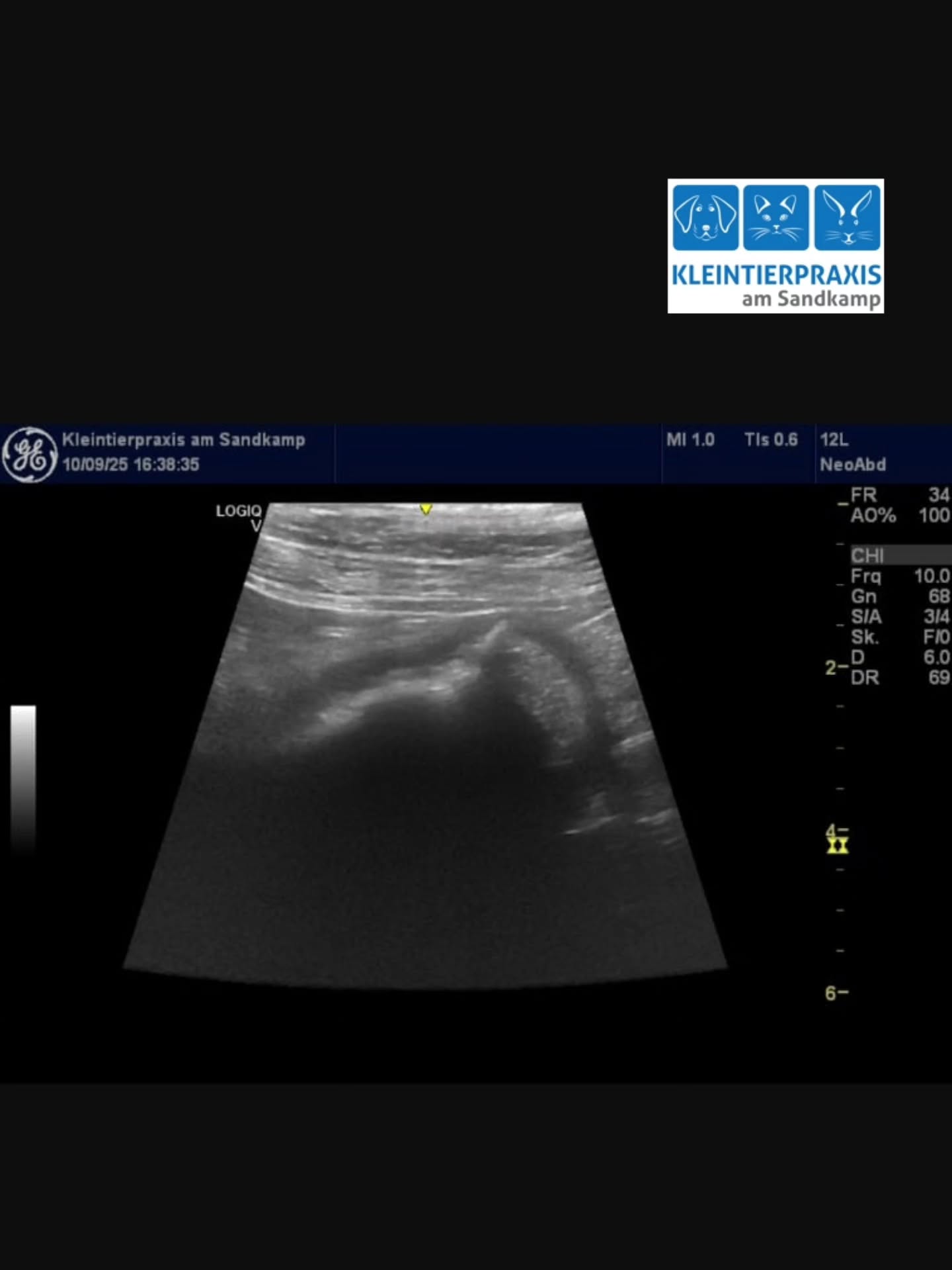 Letzte Woche wurde uns die 6 jährige Labrador Retriever Hündin "Luna" in der Nachmittagssprechstunde vorgestellt. Sie hätte seit der Mittagszeit sechs mal erbrochen, wässrigen Durchfall abgesetzt und sei nun ganz schlapp und - für uns die entscheidende Information - : Luna möchte seit dem weder fressen noch trinken. Luna ist in Beziehung Appetit eine ganz tpische Labi Hündin und wenn sie nichts mehr fressen möchte, dann handelt es sich um keine unkomplizierte Magenverstimmung!
Aus diesem Grund leiteten wir neben der allgemeinen Untersuchung sofort weitere diagnostische Maßnahmen ein: Blutuntersuchung, Röntgen und Ultraschall. In der Bildgebung konnte "Material" im Magen festgestellt werden. Wir konnten es jedoch nicht genauer definieren. Luna wurde am selben Abend mit einer Infusion und Medikamenten stabilisiert und für den nächsten Morgen zur Kontrolle einbestellt. Die Besitzer bekamen von uns eine Notfall-Telefonnummer, unter der wir bei Bedarf die Nacht über erreichbar waren.
Am nächsten Tag wurde Luna mit deutlich besserem Allgemeinbefinden vorgestellt aber sie wollte immer noch nicht fressen. In der Röntgen- und Ultraschallkontrolle konnten wir immer noch das Material sehen und der Darm erschien nun aufgegast. Wir stellten den Verdacht auf einen Darmverschluss und operierten Luna am selben Vormittag.
Wir mussten sowohl den Dünndarm als auch den Magen eröffnen und entfernten einen Putzlappen, der zum Ileus geführt hatte.
Luna erholte sich sehr schnell von der Operation und hat am selben Tag wieder mit gewohntem Appetit gefressen 😃
Mittlerweile sind die Fäden gezogen und Luna flitzt wieder durch die Gegend - und die Besitzer...passen nun ganz genau auf ihre Putzlappen auf😄