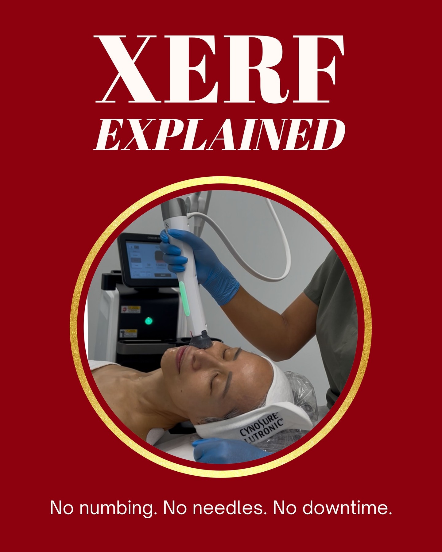 XERF Explained ✨
The next generation of skin tightening is here. With no numbing, no needles, and no downtime, XERF uses advanced RF technology to lift, firm, and restore. And personalized at three unique depths to suit your skin.
Notice results right away, with collagen building for months after. 💆
Book your free consultation today!
📍 4141 Yonge St, #304, Toronto, ON M2P 2A6
📞 (416) 481-2888
📩 info@redwoodmedispa.com
#xerf #redwoodmedispa #skinrejuvenation #torontomedispa #collagenboost #skin #skincare #treatment #skincaretreatment