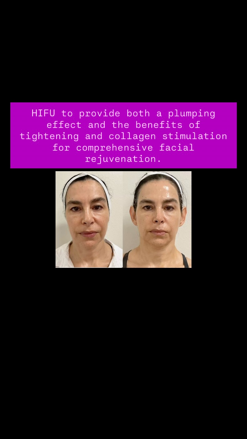 #capricebeautybar #age #sarasotaflorida #sarasota #medspa #skin #hifu #theskingames2024 #skinrejuvenation #hifulifting #siestakey #lakwoodranchfl