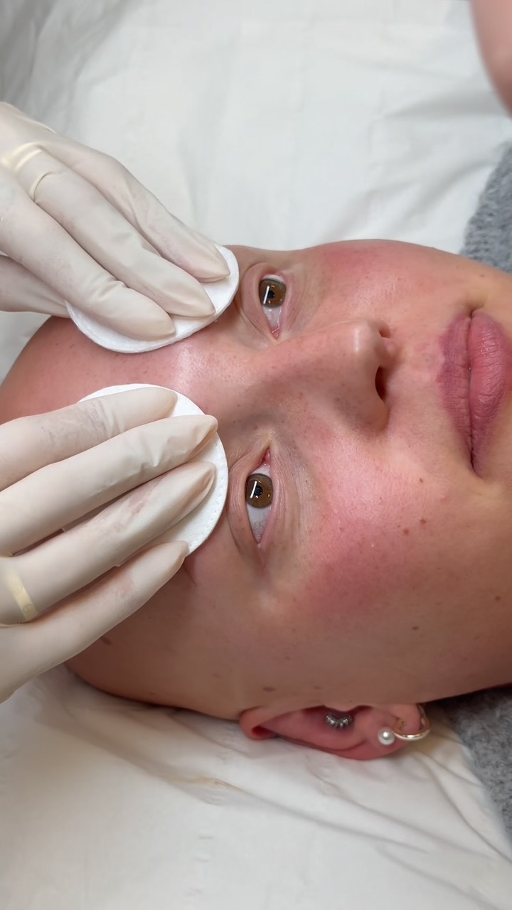 Bitte denkt daran: Worte können mehr verletzen, als ihr glaubt. Geht achtsam miteinander um – man weiß nie, welchen Kampf jemand gerade führt. ❤️
Alopecia ist eine Autoimmunerkrankung, bei der das Immunsystem die Haarfollikel angreift. Dadurch fallen Haare teilweise oder komplett aus – an Kopf, Gesicht oder Körper. Es ist keine Entscheidung, sondern eine Erkrankung.