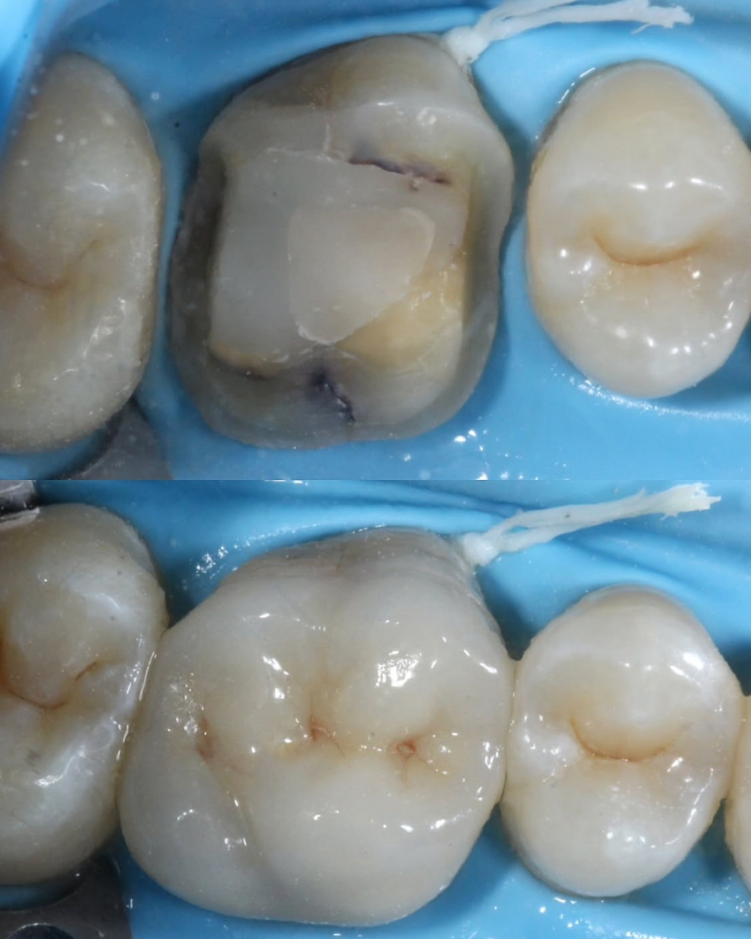 A great case by @dental_story
Ceramic Onlay Workflow for UL6
- If I can avoid DME and isolate predictably I prefer having margins on natural tooth structure
- Dual cure cements are my go-to rather than heated composite. Especially when I have a thicker onlay to cement and am worried about depth of light cure
- From my experience, butt joint finishes seem to give a better colour match between tooth and ceramic compared to margin finishes
- Temporising using polycarboxylate cements and composite tags works very predictably even with minimal retention preparations.
Get in touch with our team to book your appointment - we look forward to seeing you soon!
The London Centre For Prosthodontics
29 Weymouth Street
London, W1G 7DB
020 7637 4518
info@londonprosthodontics.com
Monday - Friday: 7:30am - 4:30pm
#MaryleboneDentist #LondonSmiles #HealthyTeethMarylebone #DentalCareLondon #SmileMakeover #MaryleboneOralHealth #LondonDentalExperts #CosmeticDentistry #TeethWhiteningMarylebone #EmergencyDentistLondon #MaryleboneOrthodontics #LondonDentalClinic #DentalCheckup #MaryleboneDentalCare #SmileTransformation
#LondonOralCare #MaryleboneDentalHealth #FamilyDentistLondon #TeethCleaningMarylebone #CosmeticDentistLondon #MaryleboneTeeth #LondonDentalHygiene#MaryleboneOrthodontist #OralWellnessLondon #PreventiveDentistry #MaryleboneDentalServices #LondonDentalSpecialists #MaryleboneHealthySmiles #LondonDentistry #AdvancedDentalCare