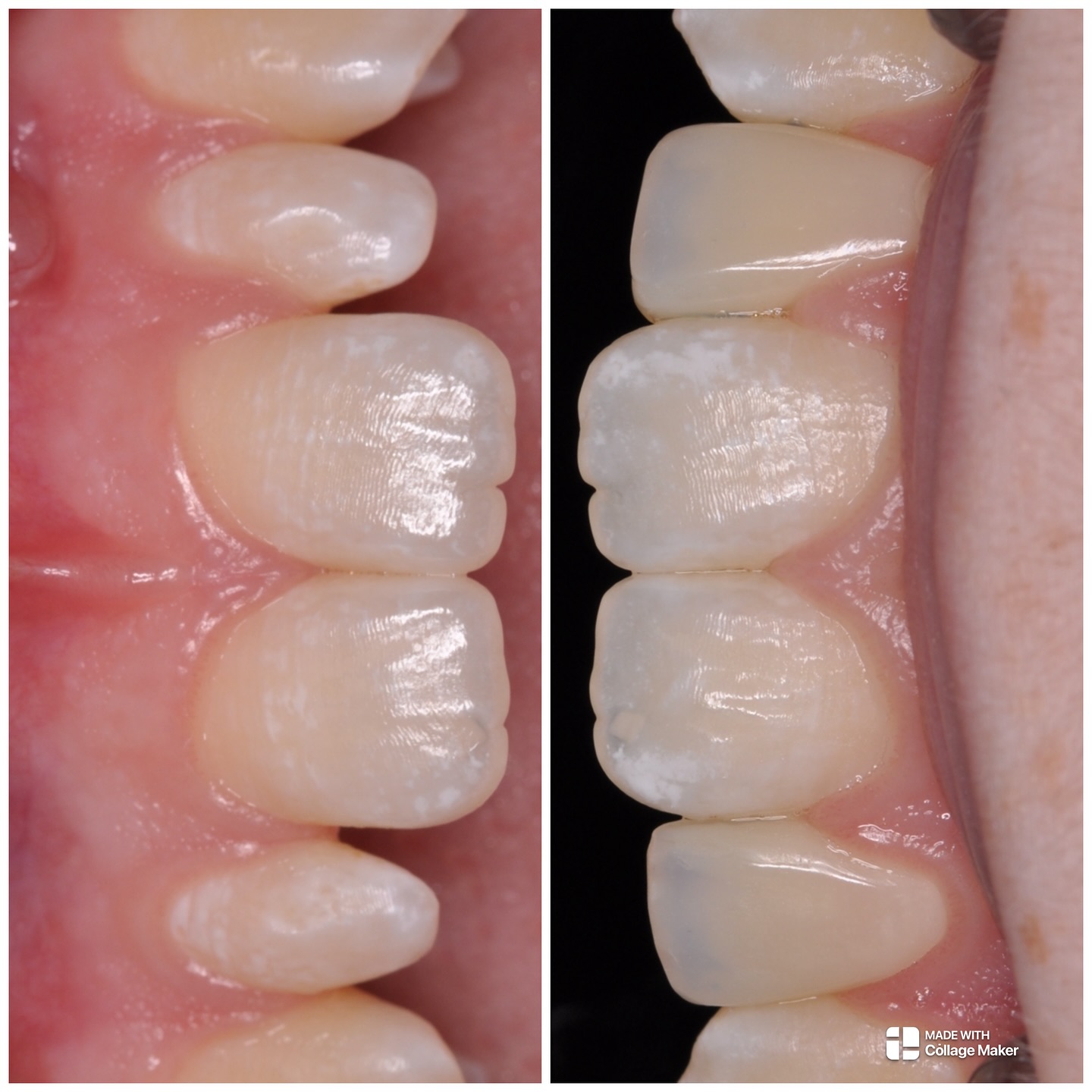 Shaping peg laterals with freehand layered composite bonding #nhs #treat #treatment #endowarrior #endodontia #rootcanaltreatment #rootcanaltherapy #endobelly #waves #waveonegold #saveteeth #endospecialist #treatyourself #simplicity #dentaltreatment #compositebonding #dentistry #endodontics #smiledesign #smilemakeover #minismilemakeover #peglaterals #peglateralcorrection