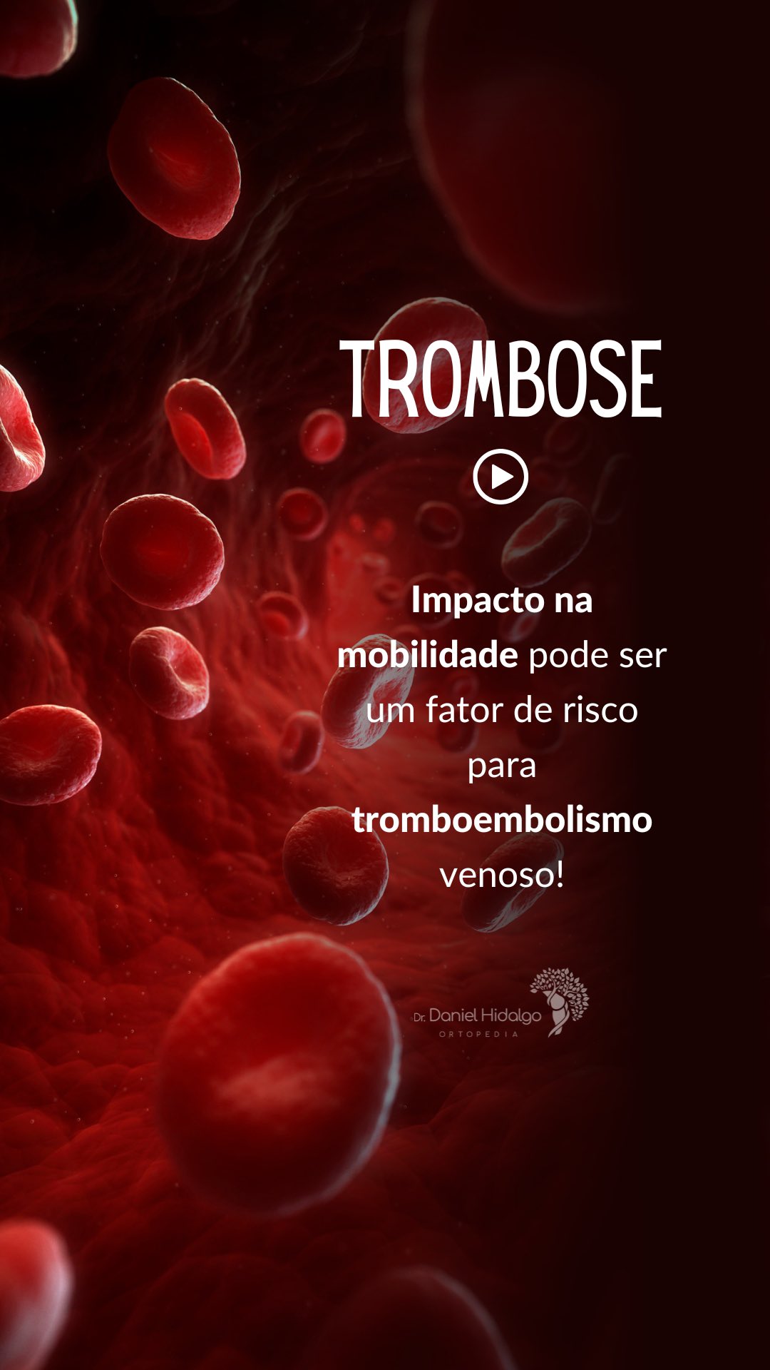 O tromboembolismo venoso pode ser uma complicação após lesões em que a mobilidade é afetada. Saiba mais! #trombose #ortopedia #joelho