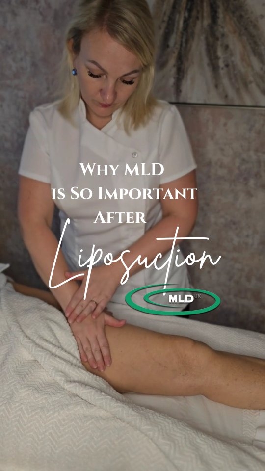 ✨ Why MLD is So Important After Liposuction ✨
Liposuction shapes the outside, but it also puts stress on the inside. That’s where Manual Lymphatic Drainage (MLD) comes in 💆♀️✨
🌿 What happens after liposuction?
Your lymphatic system becomes overloaded with excess fluid, waste products, and inflammation.
This leads to swelling, stiffness, tenderness, and sometimes fluid pockets (seromas).
Without proper care, scar tissue and fibrosis (hard, lumpy areas) may form, affecting your final results.
🌿 Possible complications without MLD:
⚠️ Excessive swelling that slows healing
⚠️ Fluid build-up (seromas) that may need draining
⚠️ Fibrosis & hard lumps, leaving uneven texture
⚠️ Prolonged bruising, discomfort & pain
⚠️ Delayed healing, increasing infection risk
⚠️ Poor scar formation
🌿 How does MLD help?
✔️ Stimulates your lymphatic system to clear waste & toxins
✔️ Speeds up healing after surgery
✔️ Reduces swelling, bruising & discomfort
✔️ Prevents seromas and fibrosis
✔️ Improves skin texture for smoother, more even results
✔️ Boosts immunity to lower infection risk
✔️ Helps you move and feel more comfortable during recovery
🌿 Plan ahead:
📅 Book your MLD sessions before your surgery so you’re prepared and organised. Supporting your body from day one makes recovery smoother and results better.
💜 Remember: Surgery is only half the journey — healing well is what makes your results last.
#MLD #ManualLymphaticDrainage #PostSurgeryCare #LiposuctionRecovery #HealingJourney #LymphaticMassage #OncologyMassage #ScarTherapy #HolisticHealing #LymphaticSystem #CosmeticSurgeryRecovery #WellnessJourney #ReflexologyHealing #SelfCareMatters #TatjanaSenkova #MLDUK #newburyberkshire