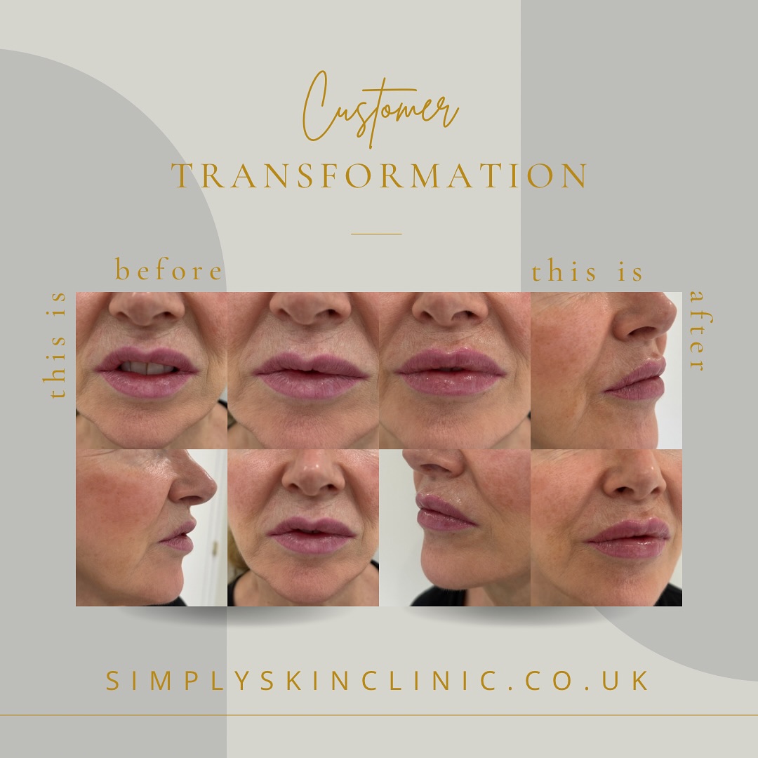 ✨ Lip Transformation ✨
Subtle, yet powerful! Using Teoxane RHA® 2, we refined the lip shape and enhanced the facial profile — giving a natural, balanced result that complements the whole face. 💋
The goal? Harmony, not overfilling. The beauty of Teoxane RHA 2 is its ability to move naturally with your expressions while restoring shape and volume.
📸 sometimes the smallest adjustments make the biggest impact.
#LipTransformation #Teoxane #DermalFillers #NaturalEnhancement #LipGoals #FacialBalance
@newenergyyoga
@newenergyfitness
@simplyskinltd