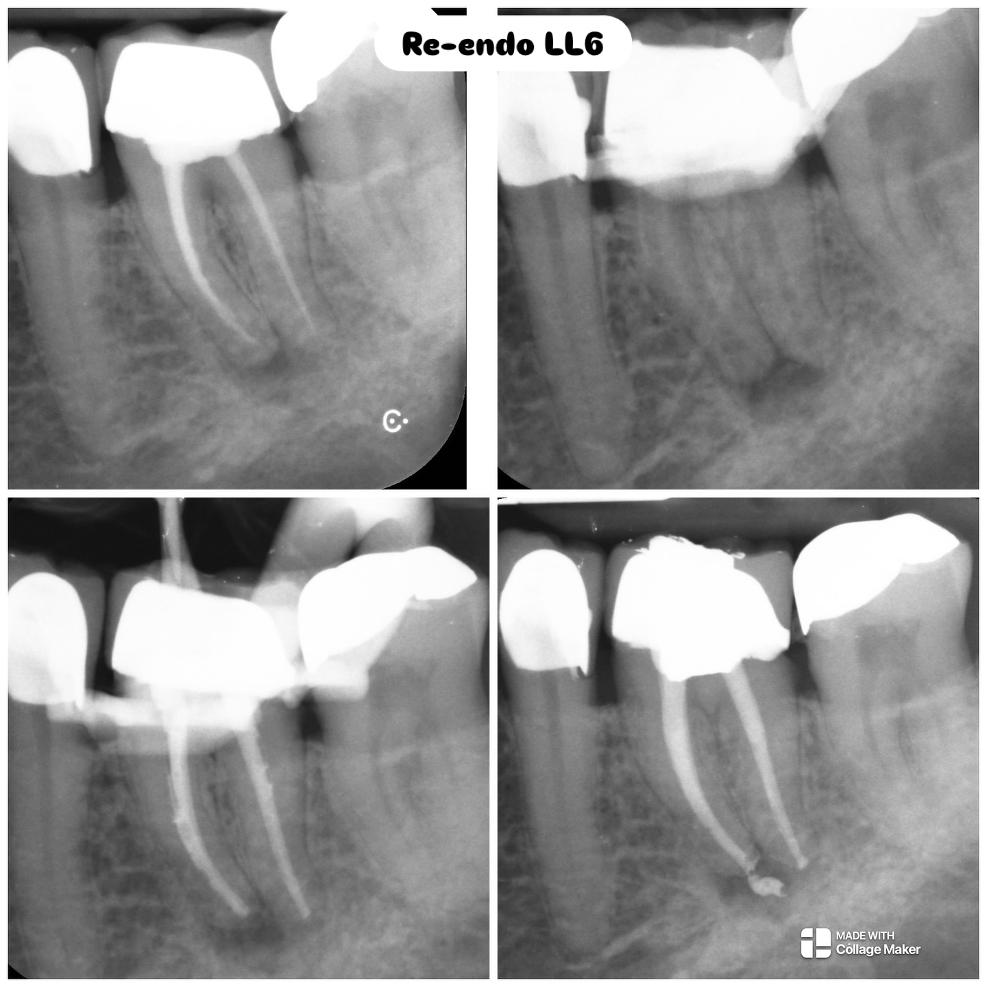 Re-treat referral LL6 (actually mesially drifted LL7). Dx previously treated, SAP. GP removal with protaper files. Oval mesial canal made gp removal a challenge. Xp file to rescue. Activated irrigation. WVC #nhs #treat #treatment #endowarrior #endodontia #rootcanaltreatment #rootcanaltherapy #endobelly #waves #waveonegold #saveteeth #endospecialist #treatyourself #simplicity #dentaltreatment #compositebonding #dentistry #endodontics #dentaltreatment #difficultendo #rerootcanaltreatment #reendo #retreatendo #rerootcanaltreatmentofmolars