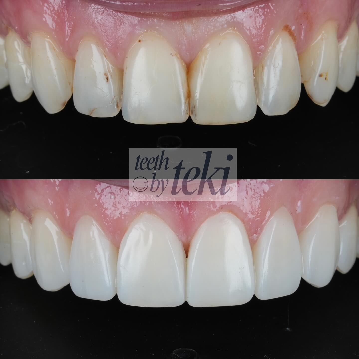 Lots of hard work lots of smiles 🦷💙
.
.
#teethbyteki #smile #workhard