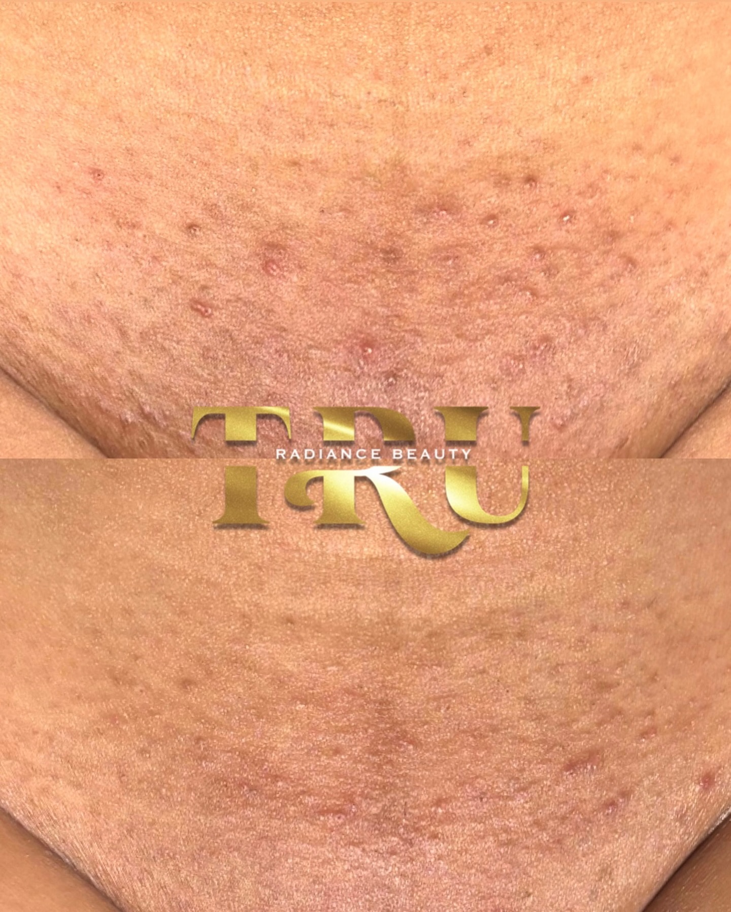 I love when my clients decide to stop being stubborn me and finally get it ! From Aug to Sept she locked in and now we got clearer skin and smoother texture !
I don’t talk to much bout my EVOLV ingrown serum enough but I should !😌
Shop EVOLV ❤️
Truradiancebeauty.com