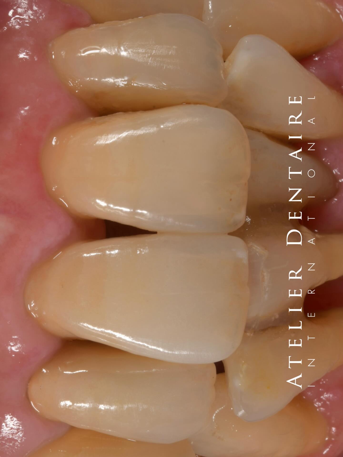 She requested ceramics that would blend in with the surrounding teeth🦷
PFZ e.max ceram
11.12
今日は経過で立ち会わせていただきました。
患者さんが本当の笑顔で喜んでいる姿を見ることができて
技工士をやっててよかったなと心から思えた日でした🥺
差し入れもいただきご馳走様でした🙇♂️
思い出に残る1ケースとなりました✨
先生いつもありがとうございます。
・
・
・
・
・
thanks
@marat_matisse.ai
@ivoclar
@uncsea
@atelierdentaire.international
#toothologyst #dentaltechnician #dentallab #dentistry #沼津歯科#静岡歯科技工士#smilemakeover #dentalceramic #morphology #layering #buildup #zirconiacrown#emaxceram #ivoclarvivadent #prosthodontics #三島市歯科医院#trios#odontologia #stomatolog #zahnarzt#dental#dentalphotography #dentist#стоматология#Dişhekimi#protetikazuba#singlecentral#straumann#シェードテイキング