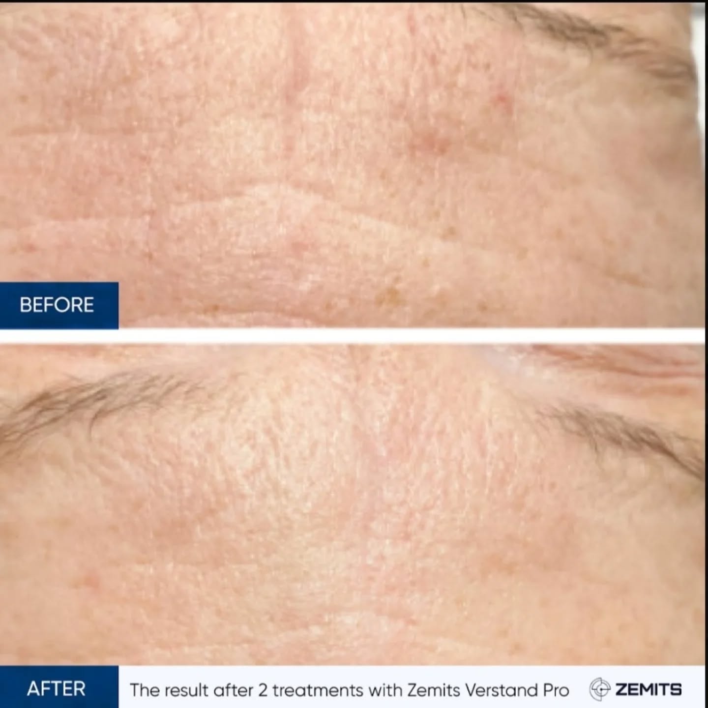 Say goodbye to fine lines, wrinkles and uneven texture with my most popular facial.
The no needle mesotherapy treatment from zemits Verstand Pro. Using award winning serums from the my filler range your face can be transformed with this unique bespoke facial suited to your skin type.
Why not transform your skin in time for the party season!
To book visit www.bbeautifulinverness.co.uk or message below