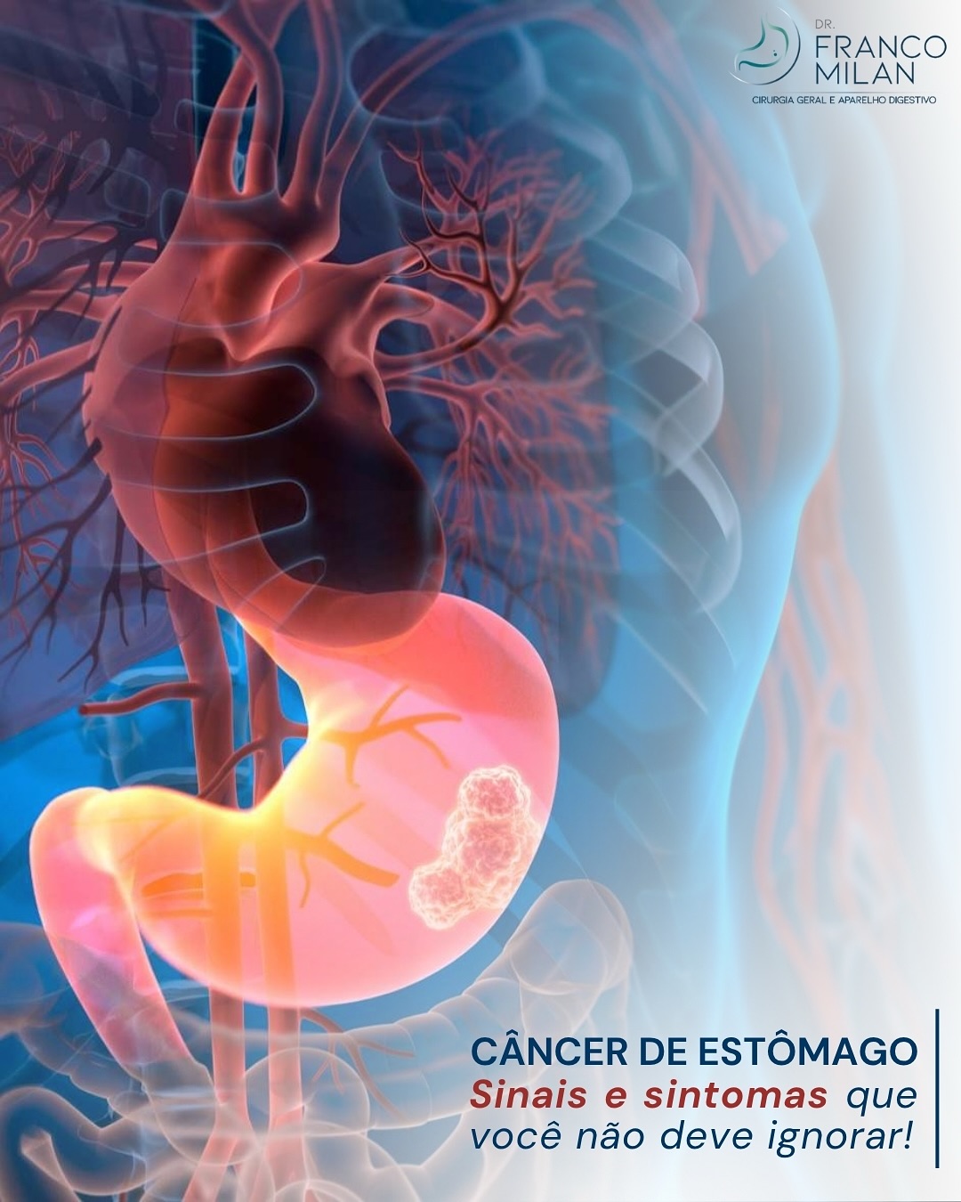 🔎 Câncer de estômago: atenção aos sinais precoces
O câncer gástrico é uma doença que exige diagnóstico precoce para melhores resultados no tratamento. Muitas vezes os sintomas iniciais podem ser discretos, como azia persistente, dor abdominal, perda de apetite, náuseas ou sensação de estufamento após pequenas refeições.
A prevenção começa com hábitos de vida saudáveis: evitar excesso de alimentos ultraprocessados, embutidos e defumados, reduzir o consumo de álcool e tabaco, além de tratar adequadamente infecções como a Helicobacter pylori.
O acompanhamento regular com médico-cirurgião ou especialista em aparelho digestivo é fundamental para investigação precoce e rastreio em pacientes de risco. Quanto mais cedo o diagnóstico, maiores as chances de cura.
⚠️ Cuide do seu estômago, cuide da sua saúde.
#CâncerDeEstômago #Gastroenterologia #SaúdeDigestiva #Cirurgia #Prevenção #Oncologia #Saúde #Medicina #DiagnósticoPrecoce #cirurgiageral #gastro #drfrancomilan
